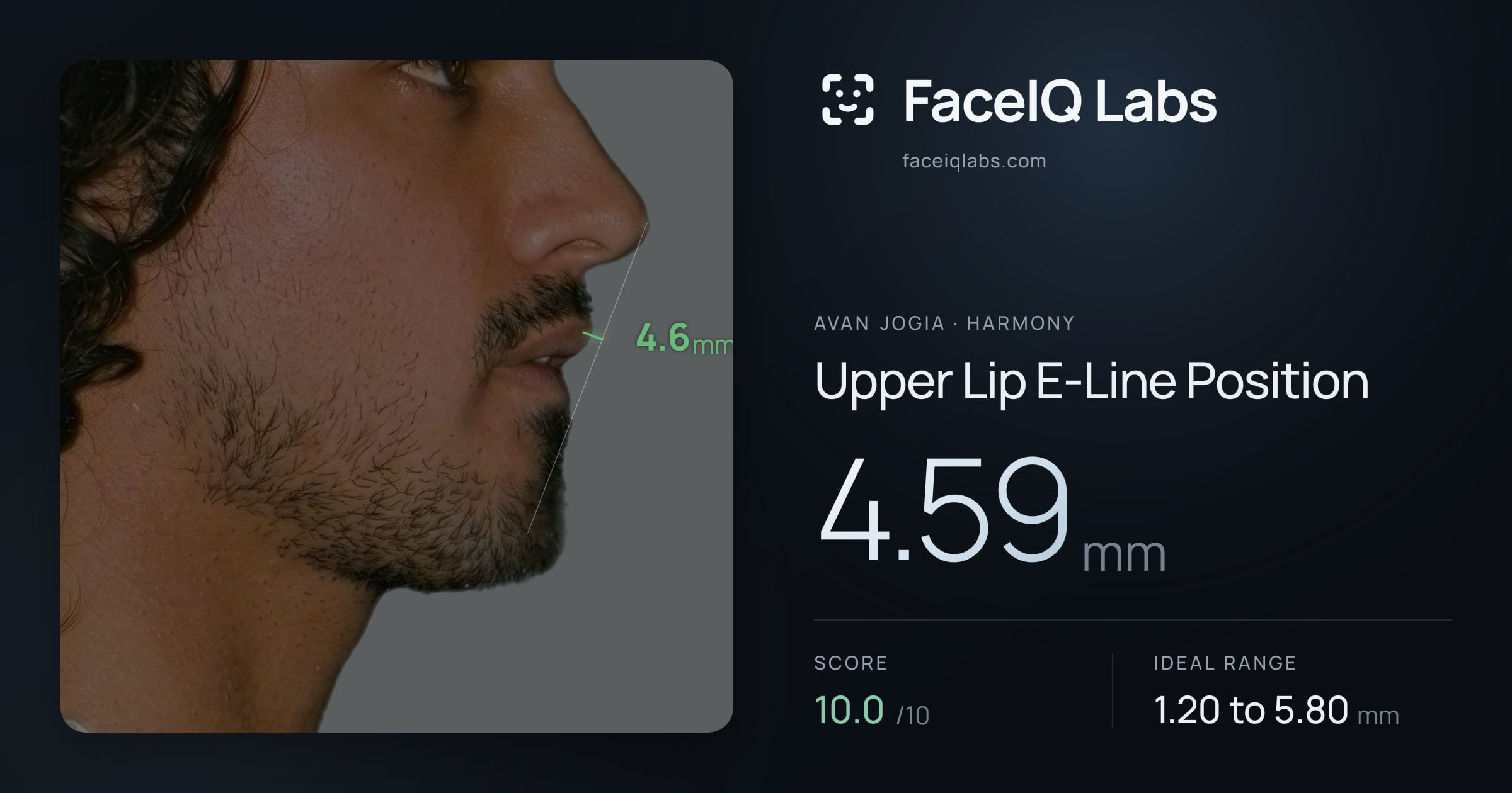 Avan Jogia Upper Lip E-Line Position: 4.59mm, drawn on the photo