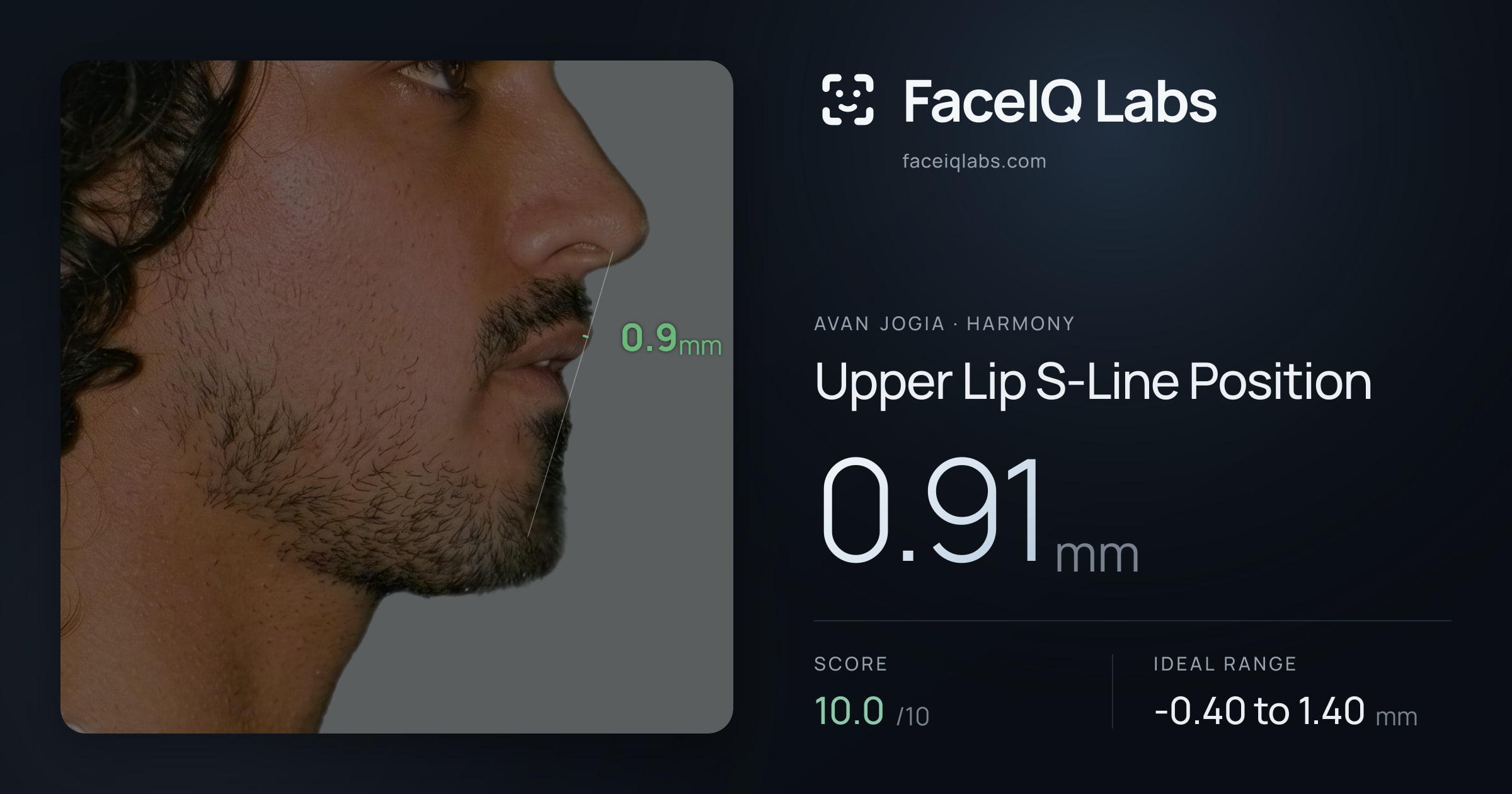 Avan Jogia Upper Lip S-Line Position: 0.91mm, drawn on the photo