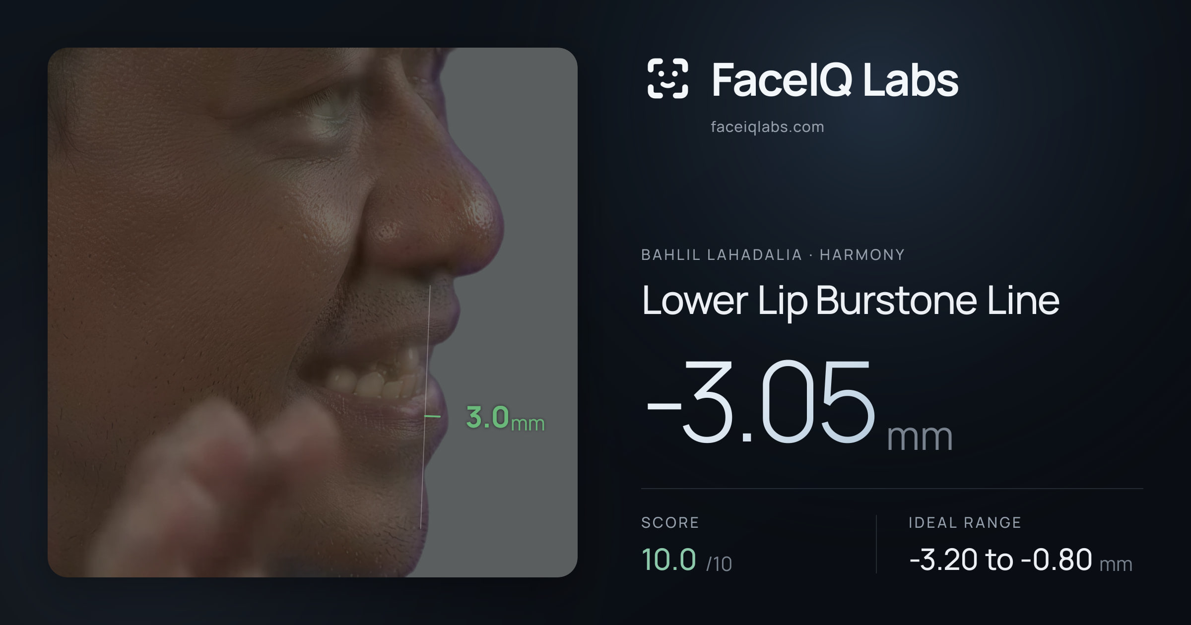 Bahlil Lahadalia Lower Lip Burstone Line: -3.05mm, drawn on the photo