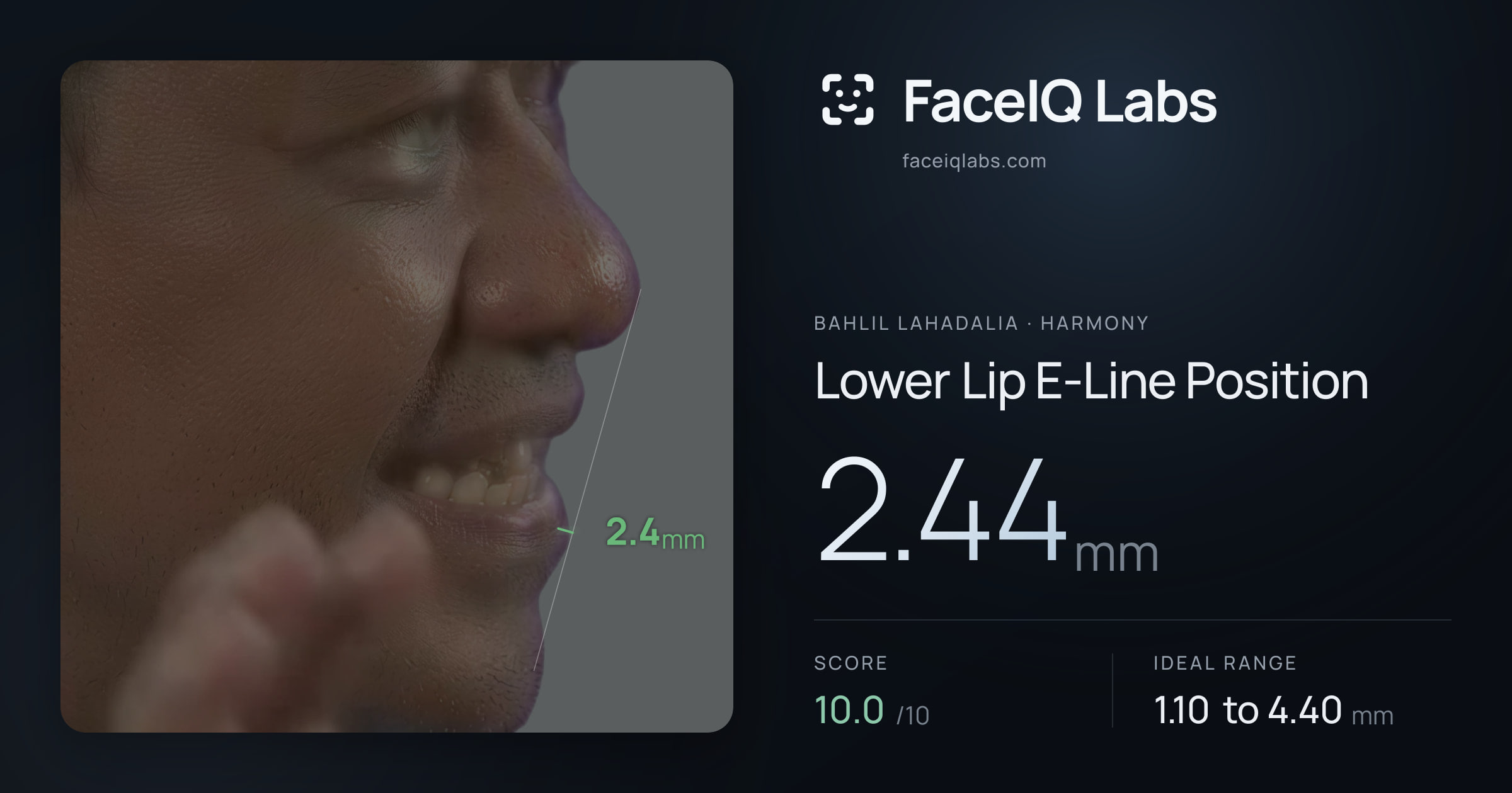 Bahlil Lahadalia Lower Lip E-Line Position: 2.44mm, drawn on the photo