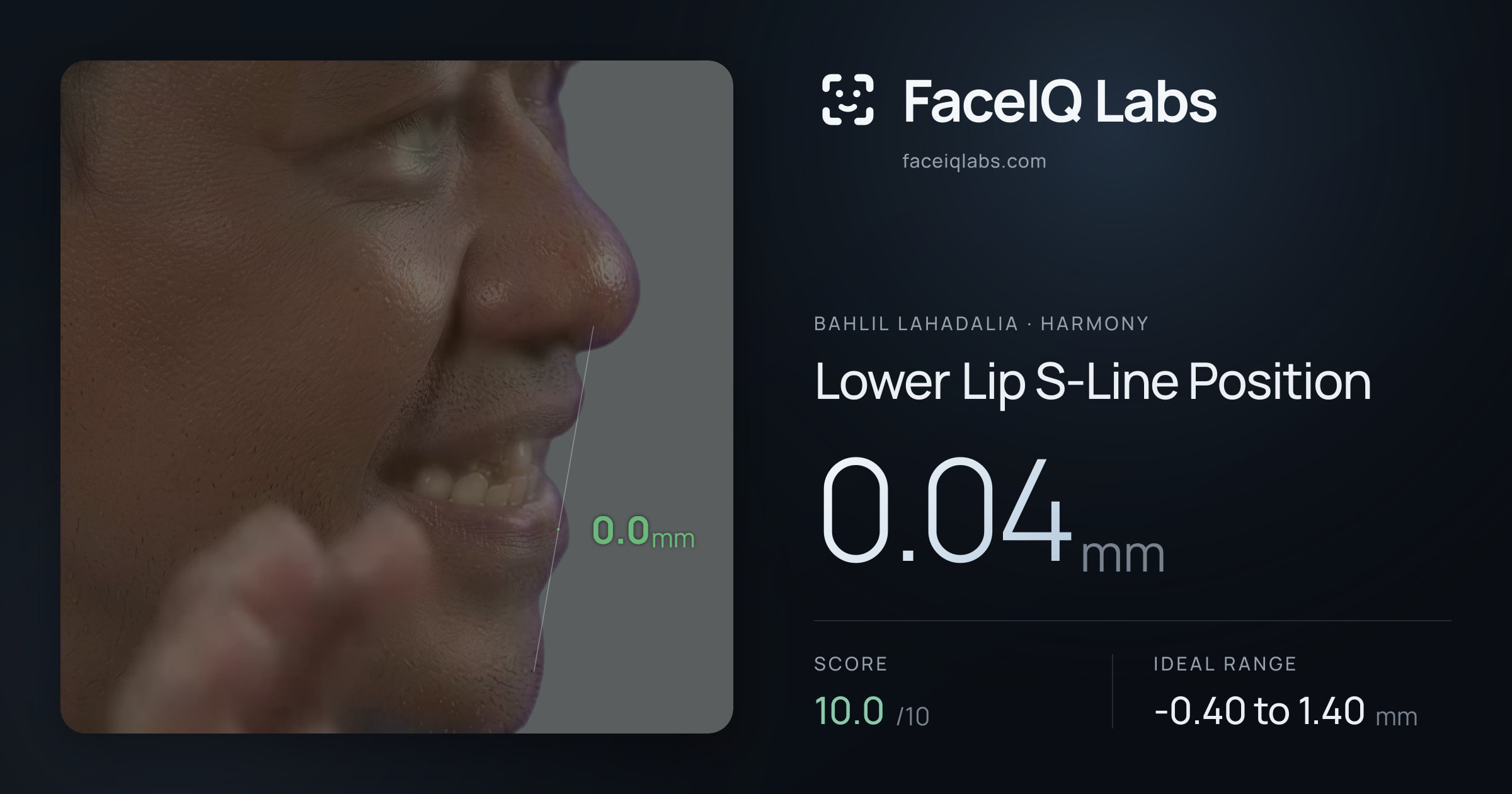 Bahlil Lahadalia Lower Lip S-Line Position: 0.04mm, drawn on the photo