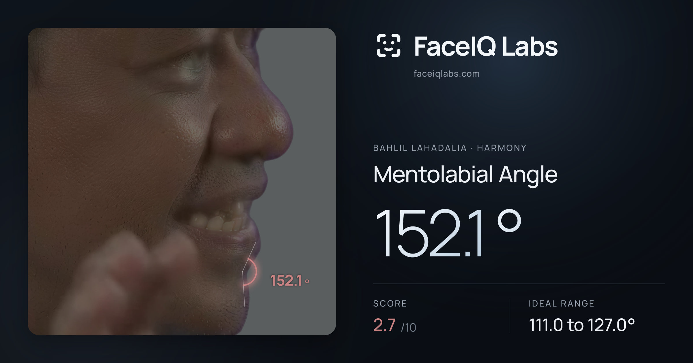 Bahlil Lahadalia Mentolabial Angle: 152.1°, drawn on the photo