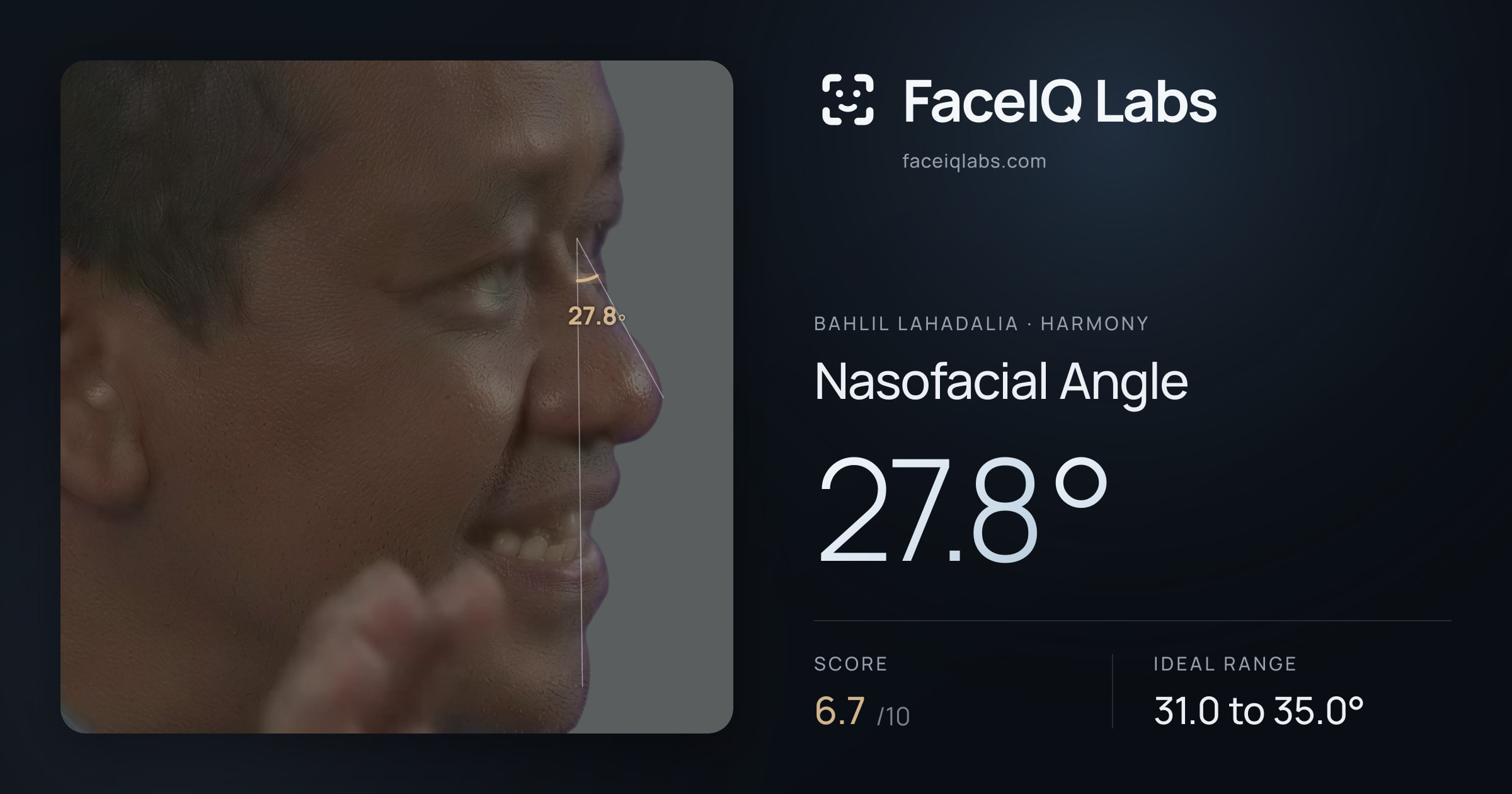 Bahlil Lahadalia Nasofacial Angle: 27.8°, drawn on the photo