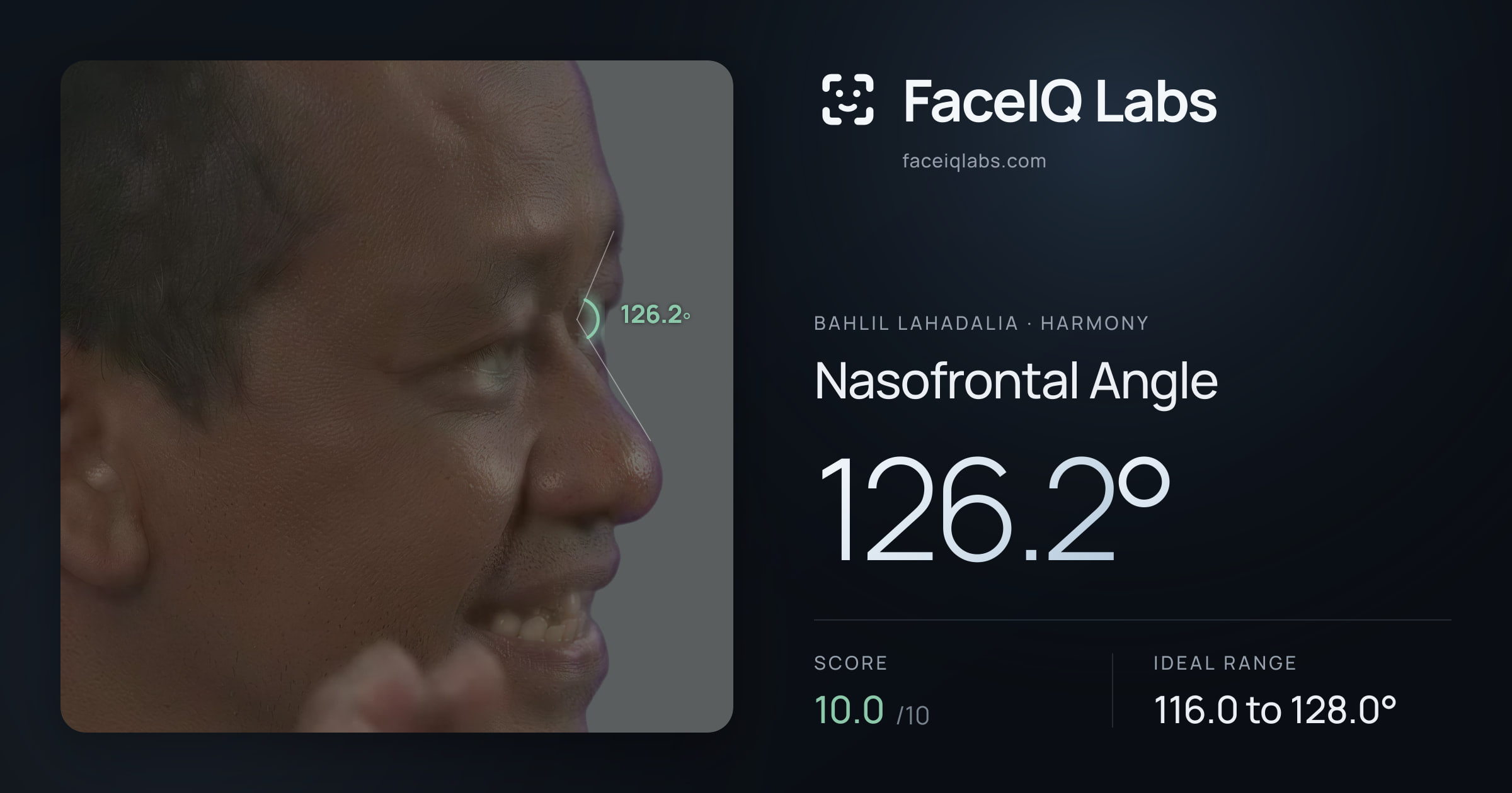 Bahlil Lahadalia Nasofrontal Angle: 126.2°, drawn on the photo
