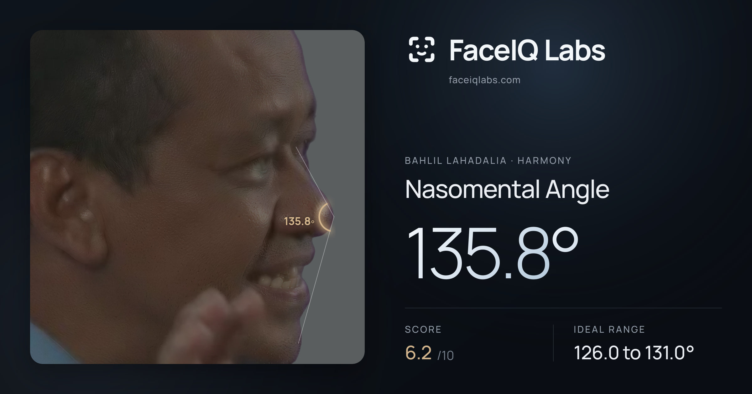 Bahlil Lahadalia Nasomental Angle: 135.8°, drawn on the photo