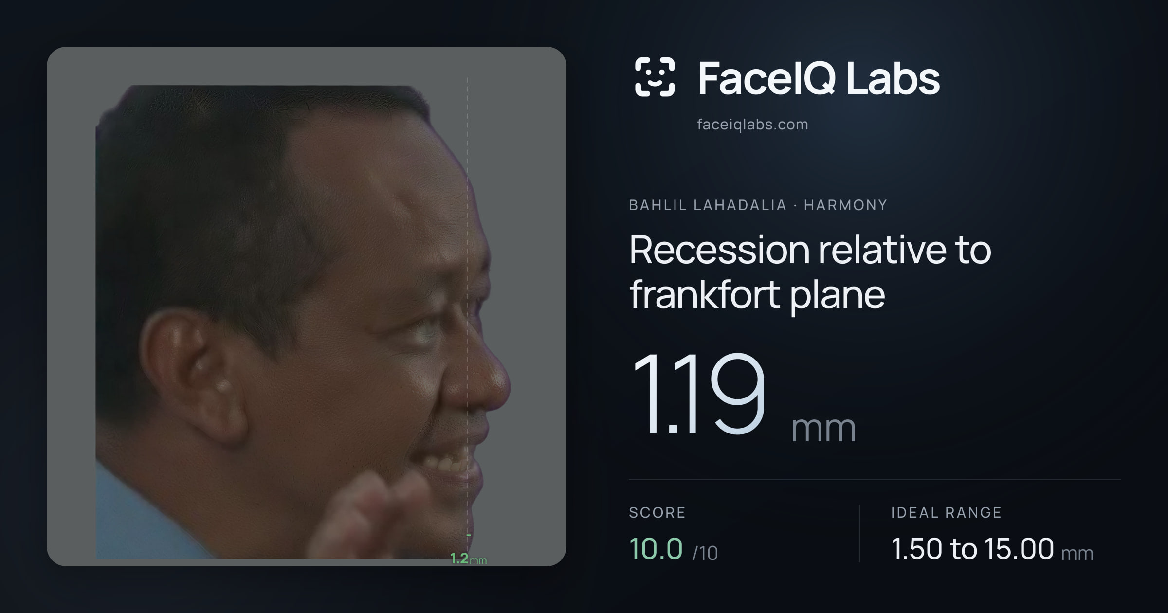 Bahlil Lahadalia Recession relative to frankfort plane: 1.19mm, drawn on the photo