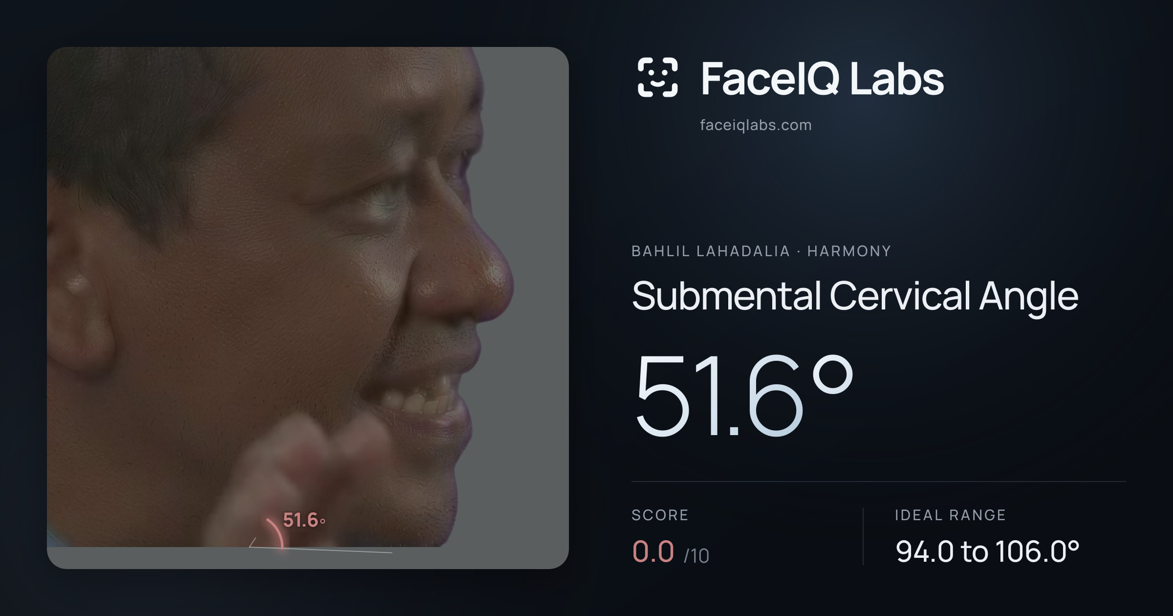 Bahlil Lahadalia Submental Cervical Angle: 51.6°, drawn on the photo