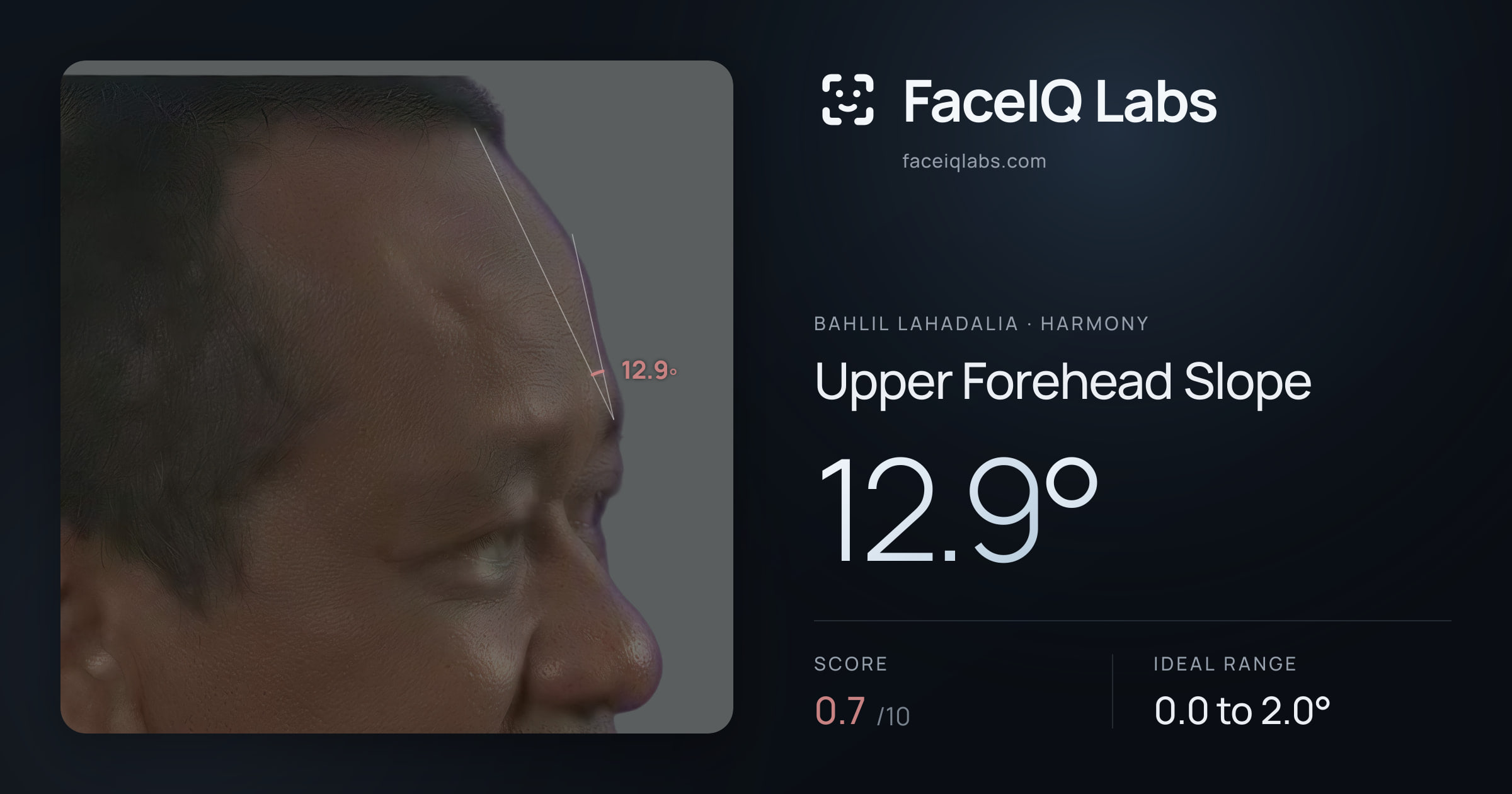 Bahlil Lahadalia Upper Forehead Slope: 12.9°, drawn on the photo
