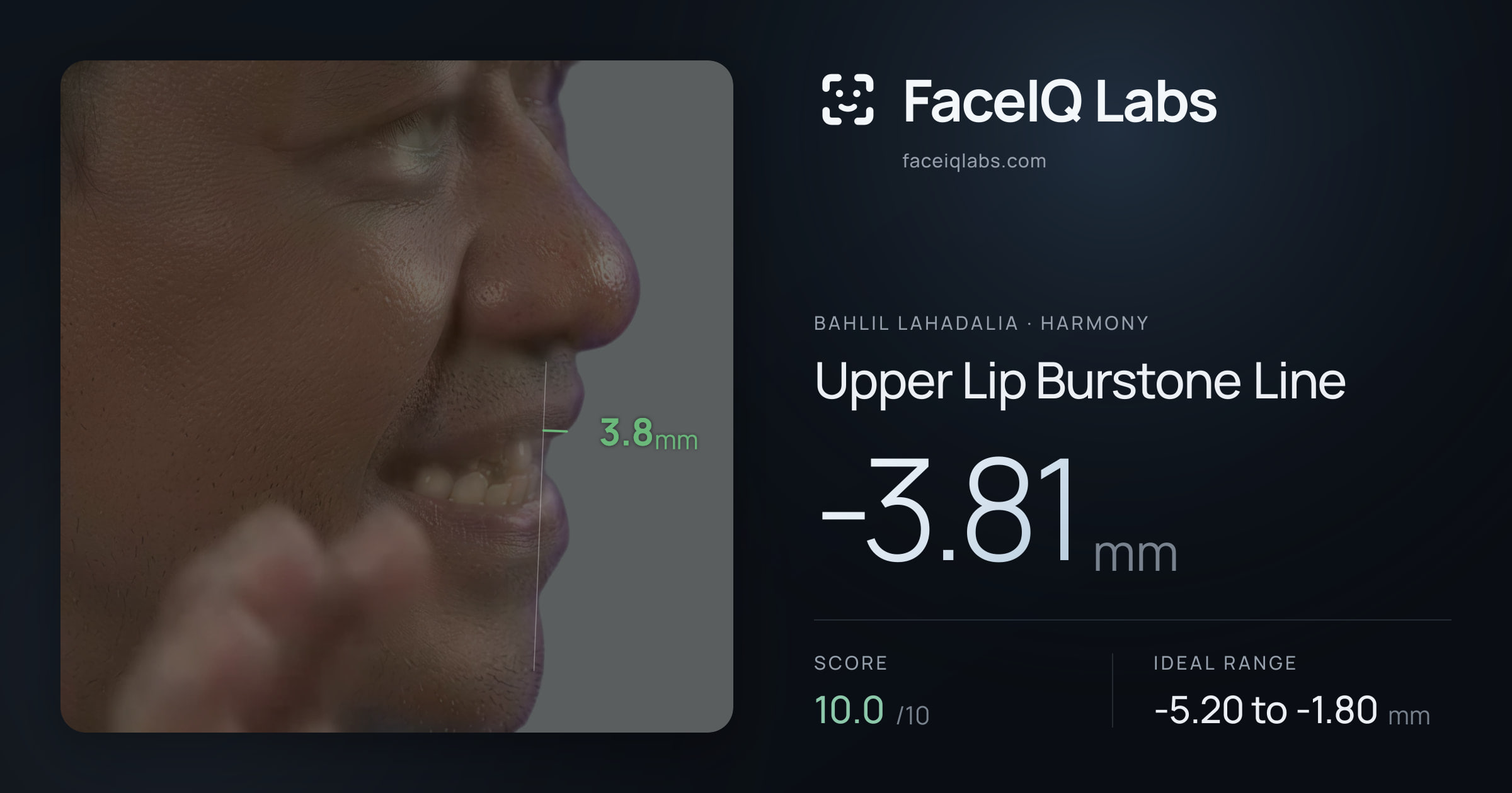Bahlil Lahadalia Upper Lip Burstone Line: -3.81mm, drawn on the photo