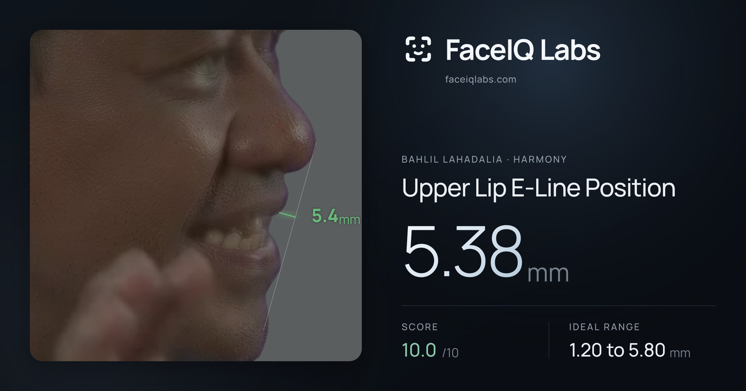 Bahlil Lahadalia Upper Lip E-Line Position: 5.38mm, drawn on the photo