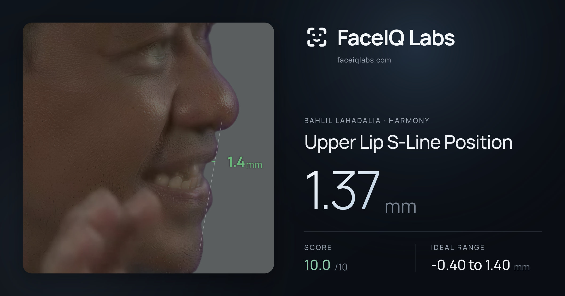 Bahlil Lahadalia Upper Lip S-Line Position: 1.37mm, drawn on the photo