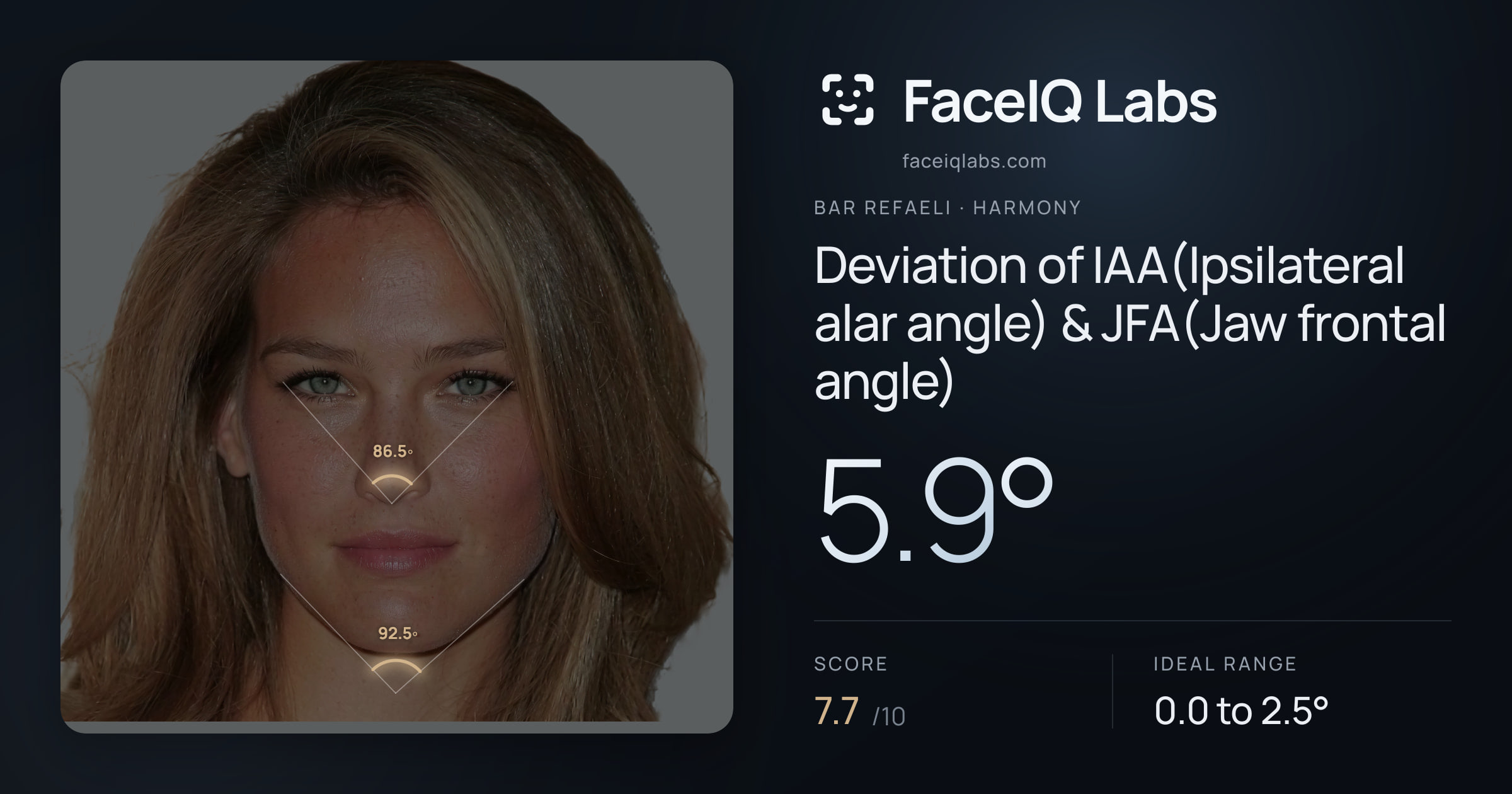 Bar Refaeli Deviation of IAA(Ipsilateral alar angle) & JFA(Jaw frontal angle): 5.9°, drawn on the photo