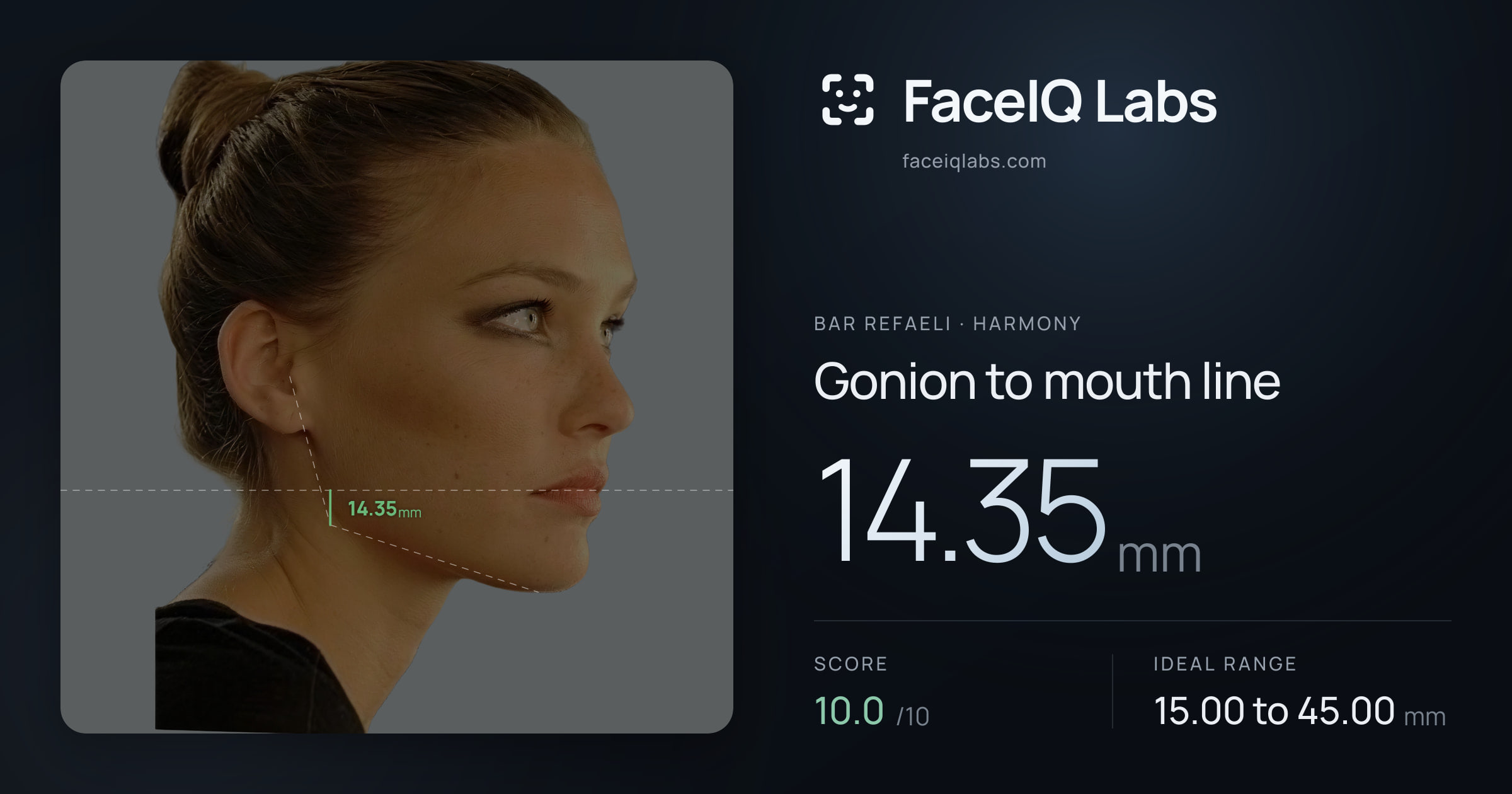 Bar Refaeli Gonion to mouth line: 14.35mm, drawn on the photo
