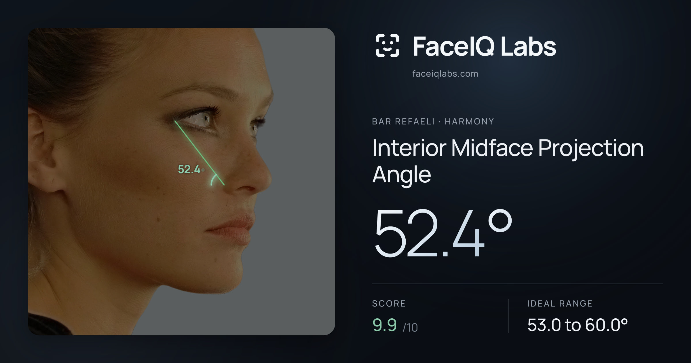 Bar Refaeli Interior Midface Projection Angle: 52.4°, drawn on the photo