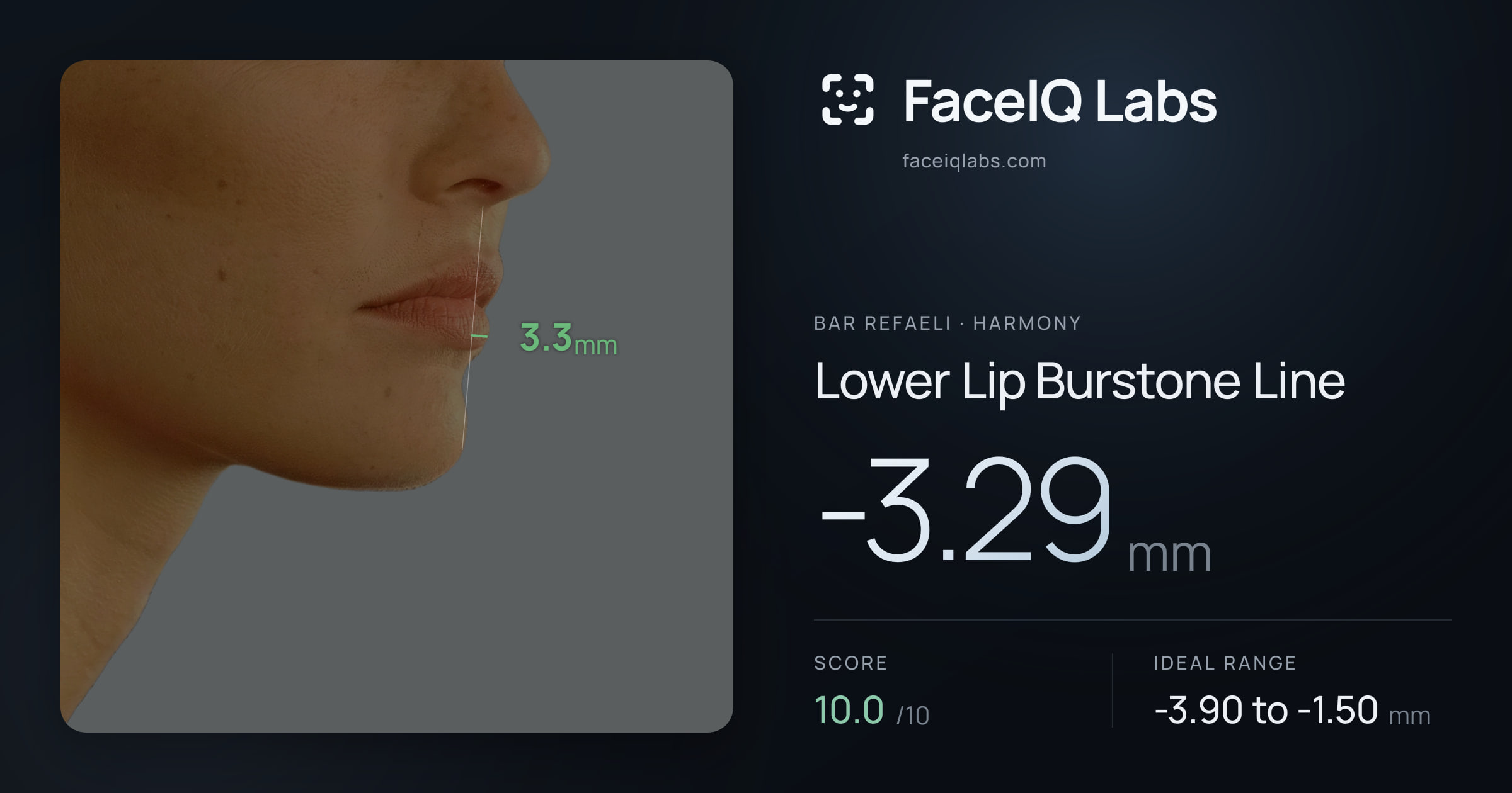 Bar Refaeli Lower Lip Burstone Line: -3.29mm, drawn on the photo