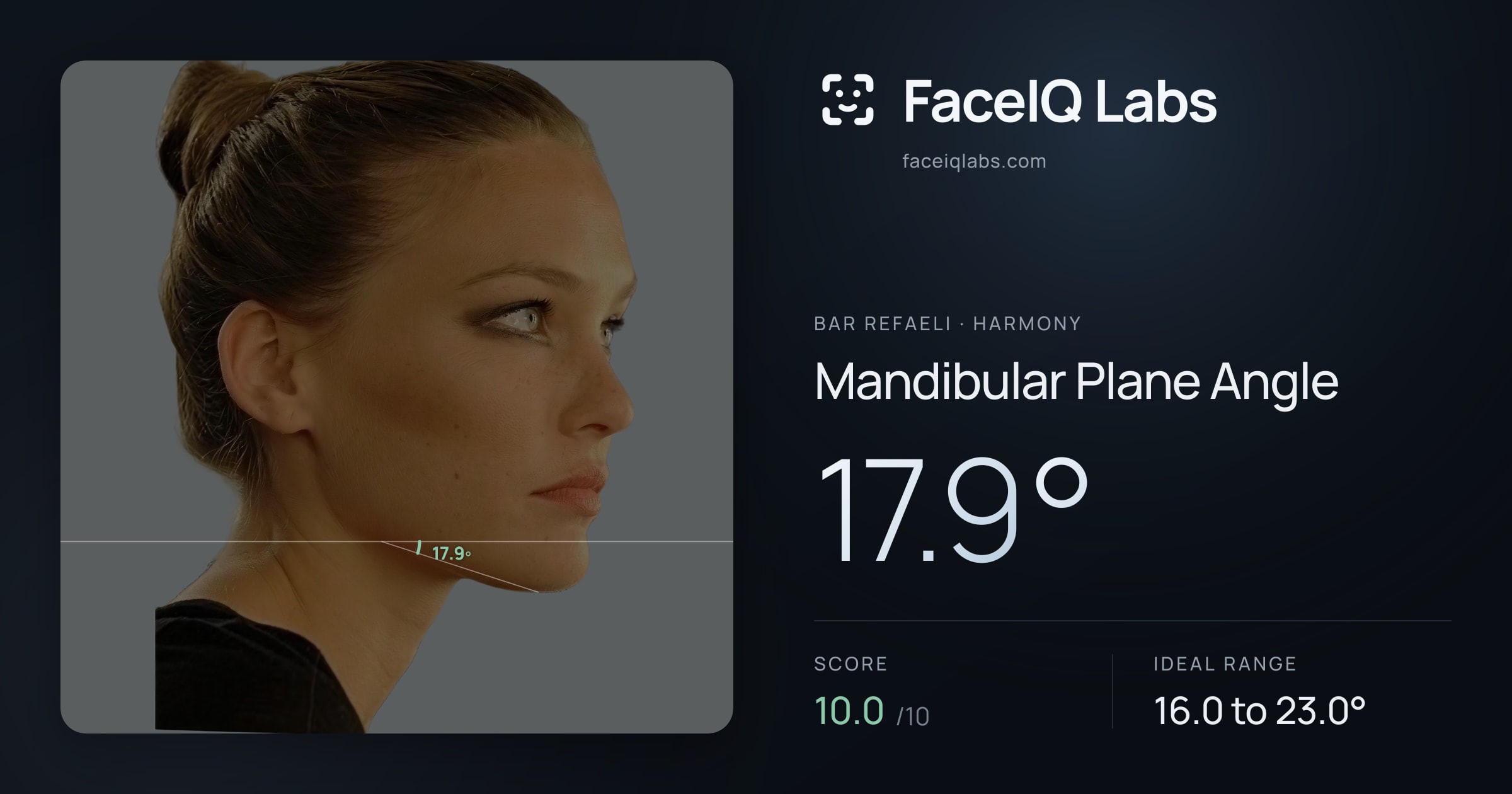 Bar Refaeli Mandibular Plane Angle: 17.9°, drawn on the photo