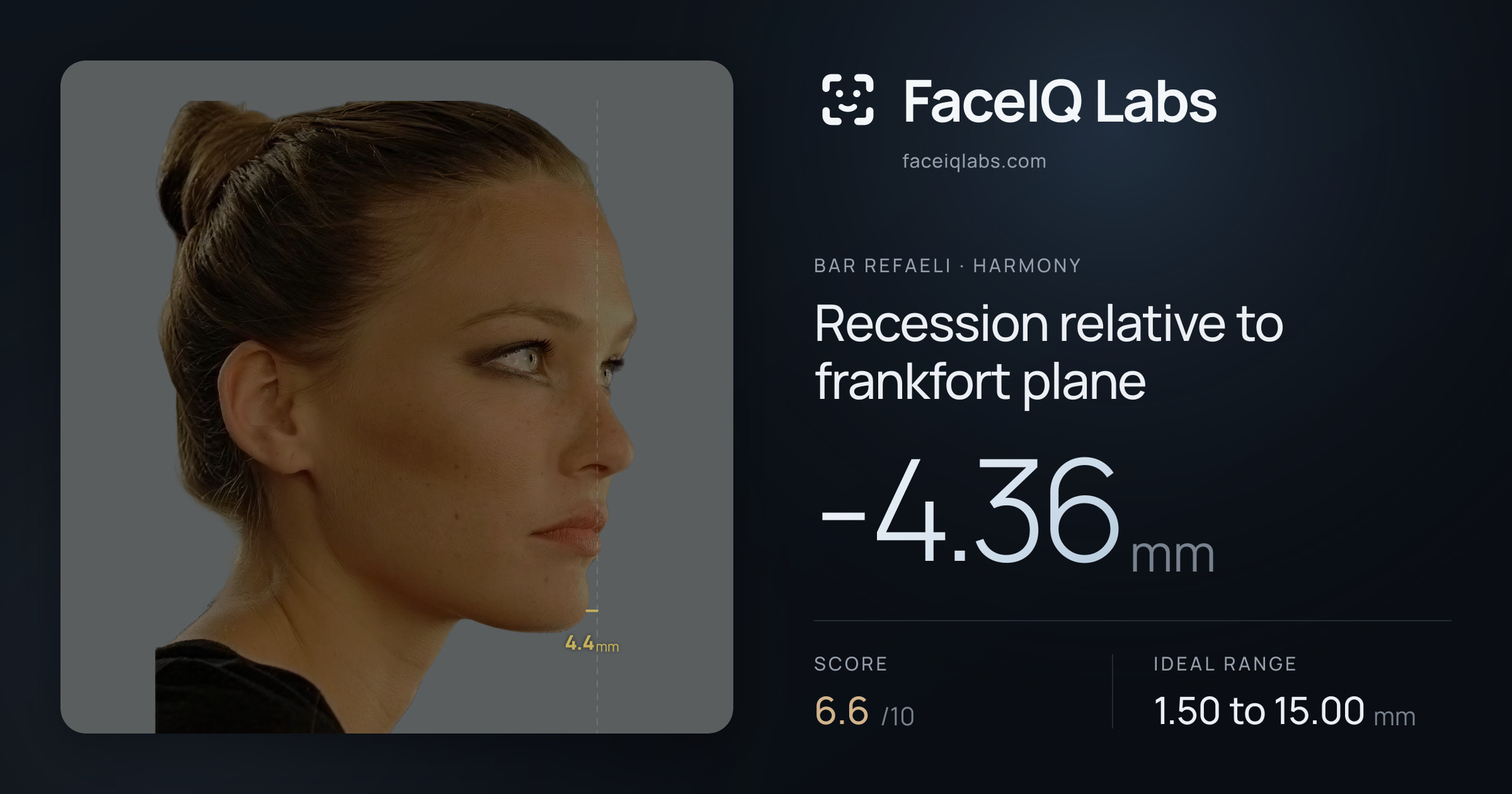 Bar Refaeli Recession relative to frankfort plane: -4.36mm, drawn on the photo