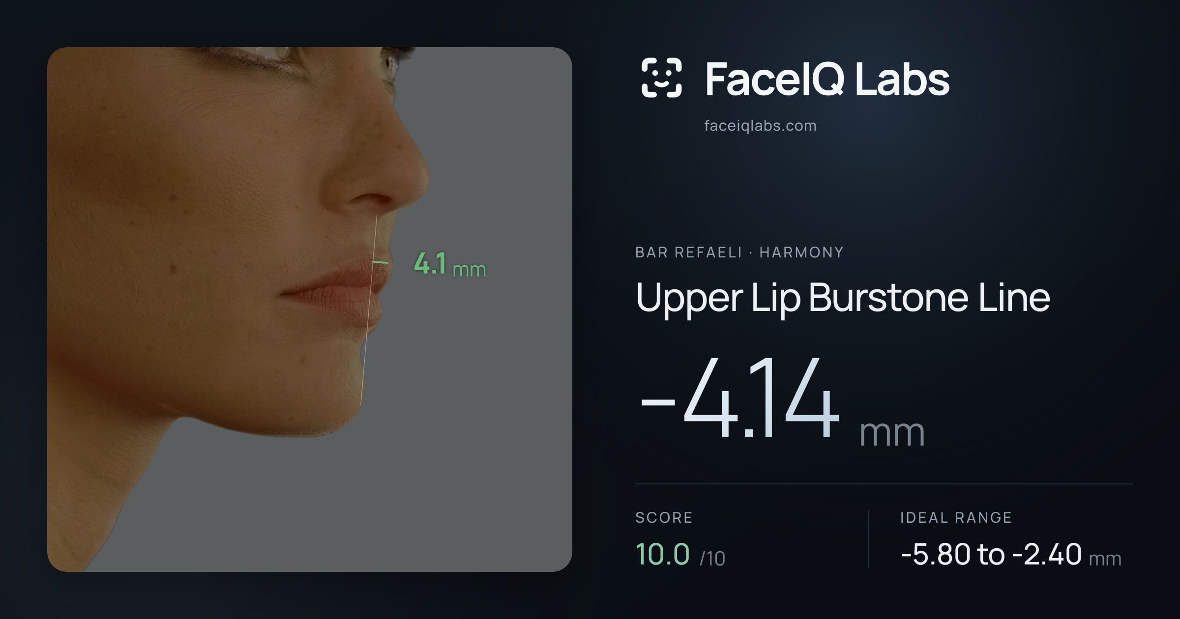 Bar Refaeli Upper Lip Burstone Line: -4.14mm, drawn on the photo