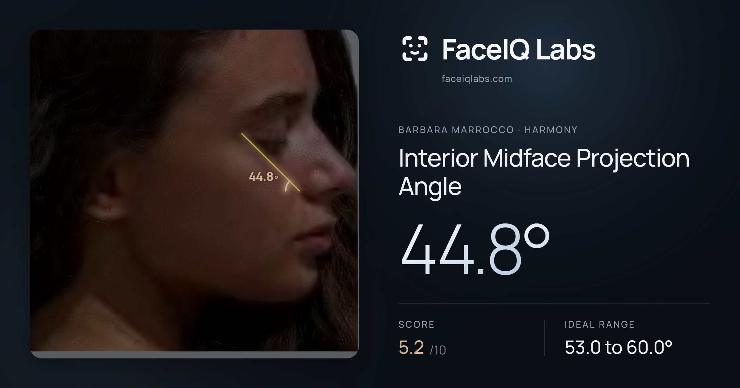 Barbara Marrocco Interior Midface Projection Angle: 44.8°, drawn on the photo