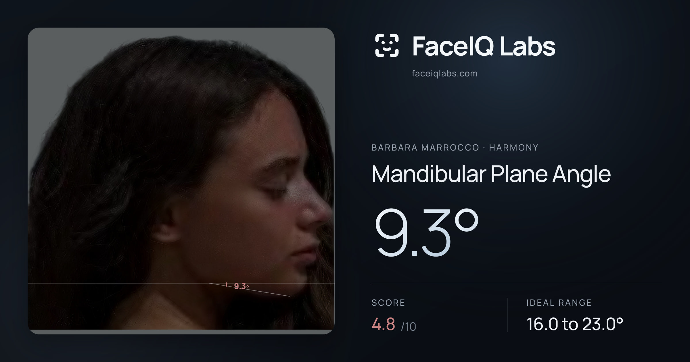 Barbara Marrocco Mandibular Plane Angle: 9.3°, drawn on the photo