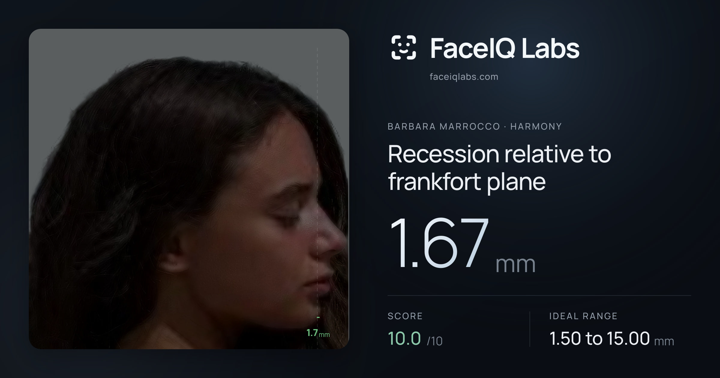 Barbara Marrocco Recession relative to frankfort plane: 1.67mm, drawn on the photo