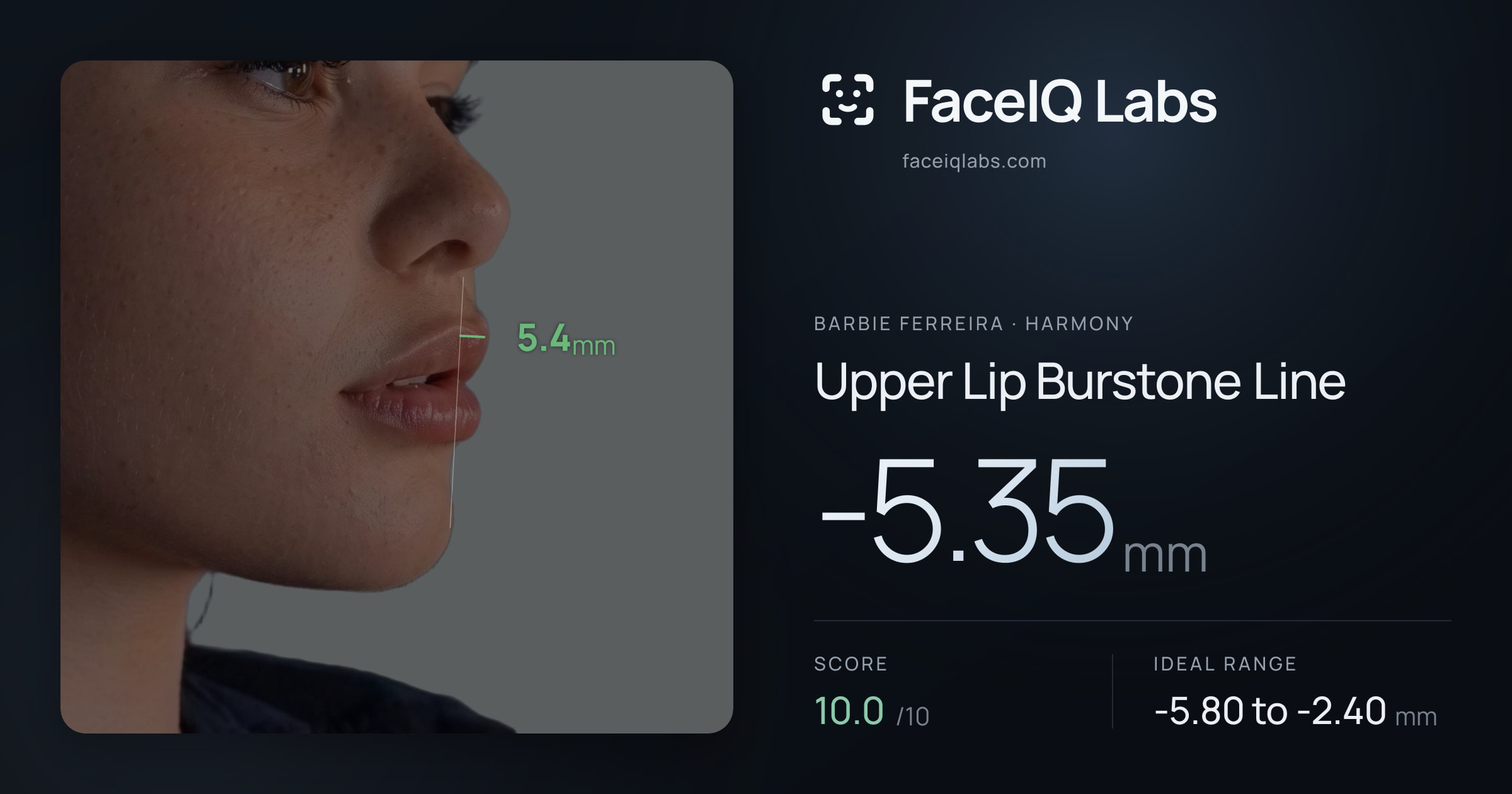 Barbie Ferreira Upper Lip Burstone Line: -5.35mm, drawn on the photo