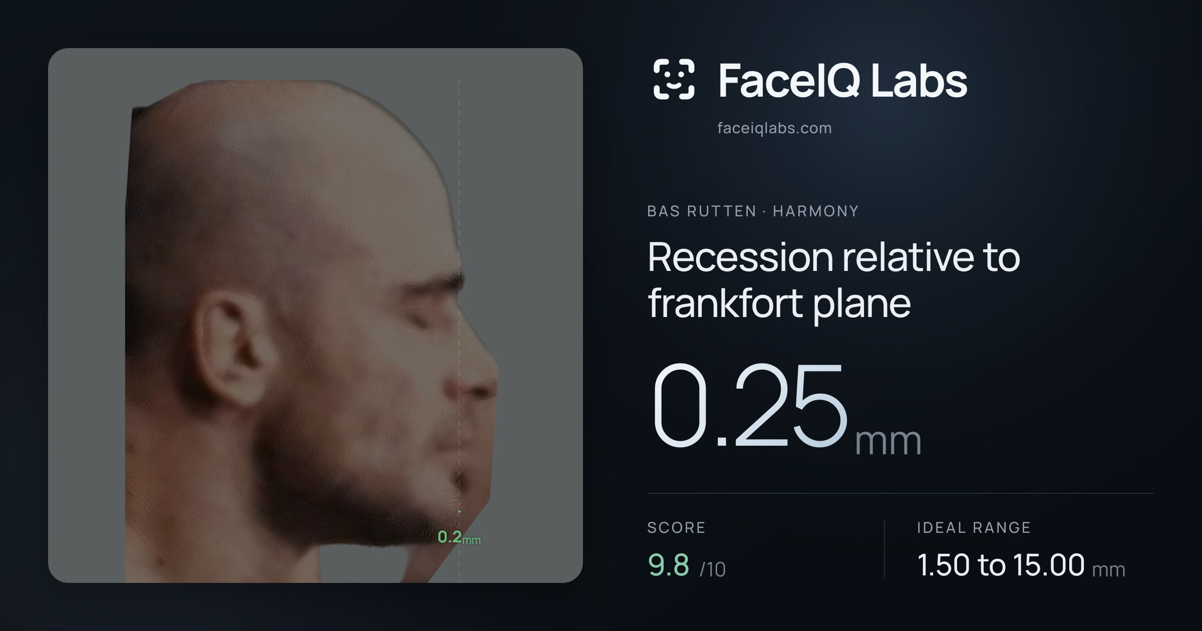 Bas Rutten Recession relative to frankfort plane: 0.25mm, drawn on the photo