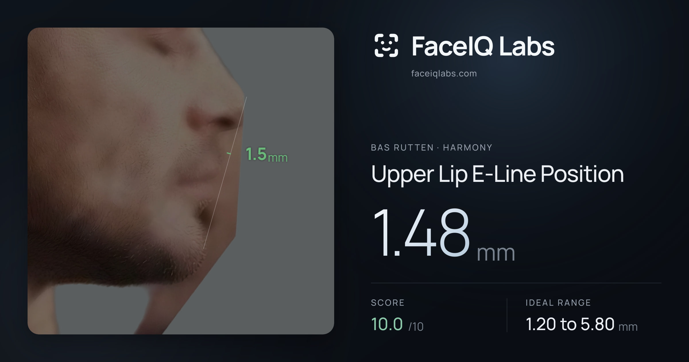 Bas Rutten Upper Lip E-Line Position: 1.48mm, drawn on the photo