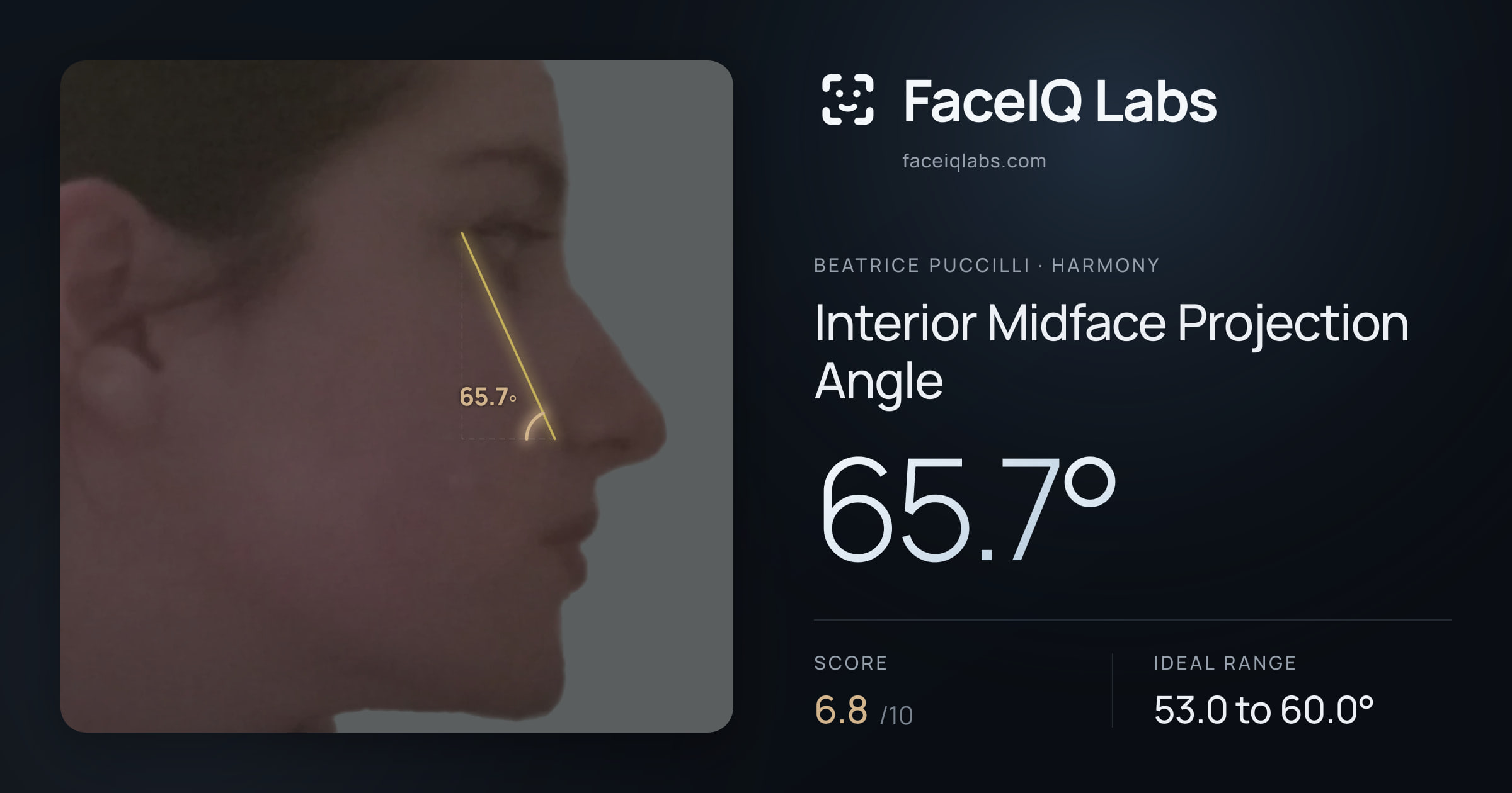 Beatrice Puccilli Interior Midface Projection Angle: 65.7°, drawn on the photo