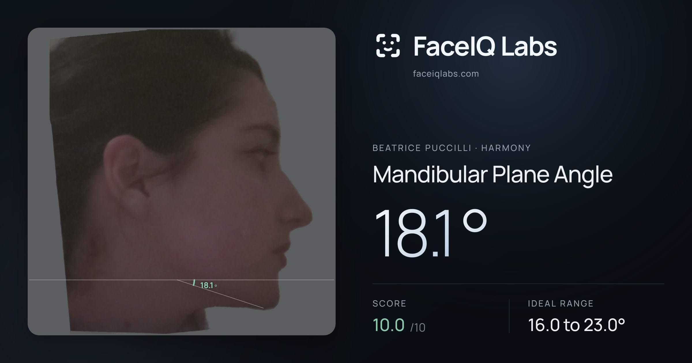 Beatrice Puccilli Mandibular Plane Angle: 18.1°, drawn on the photo