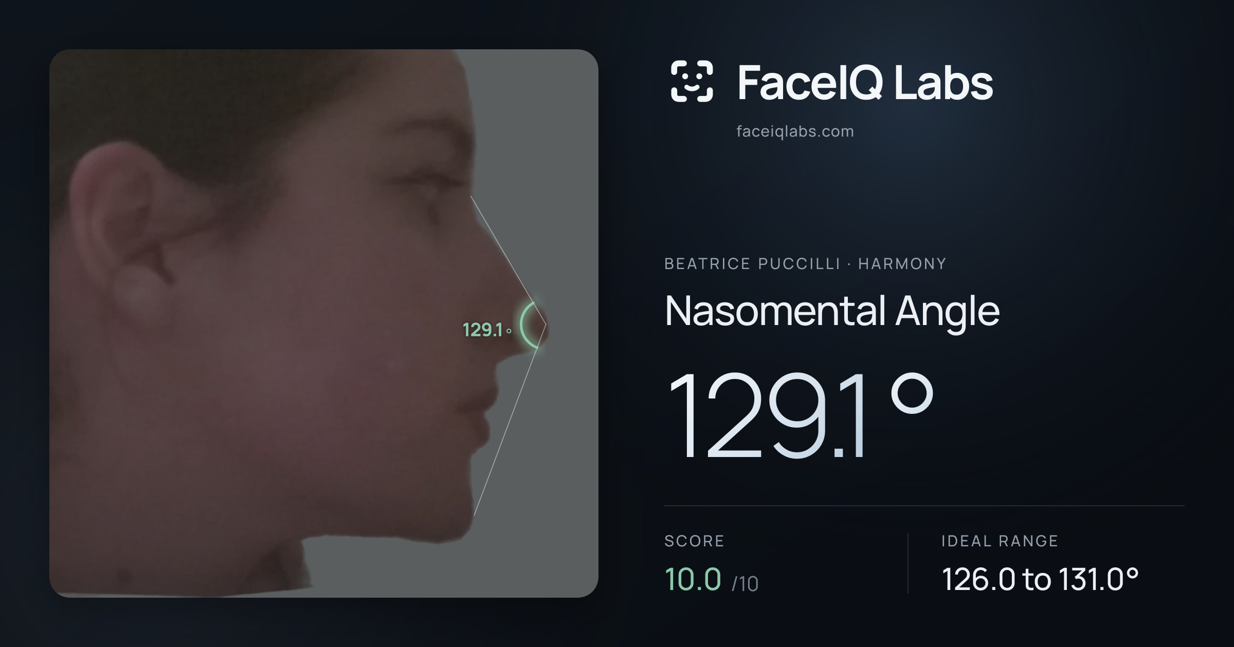 Beatrice Puccilli Nasomental Angle: 129.1°, drawn on the photo
