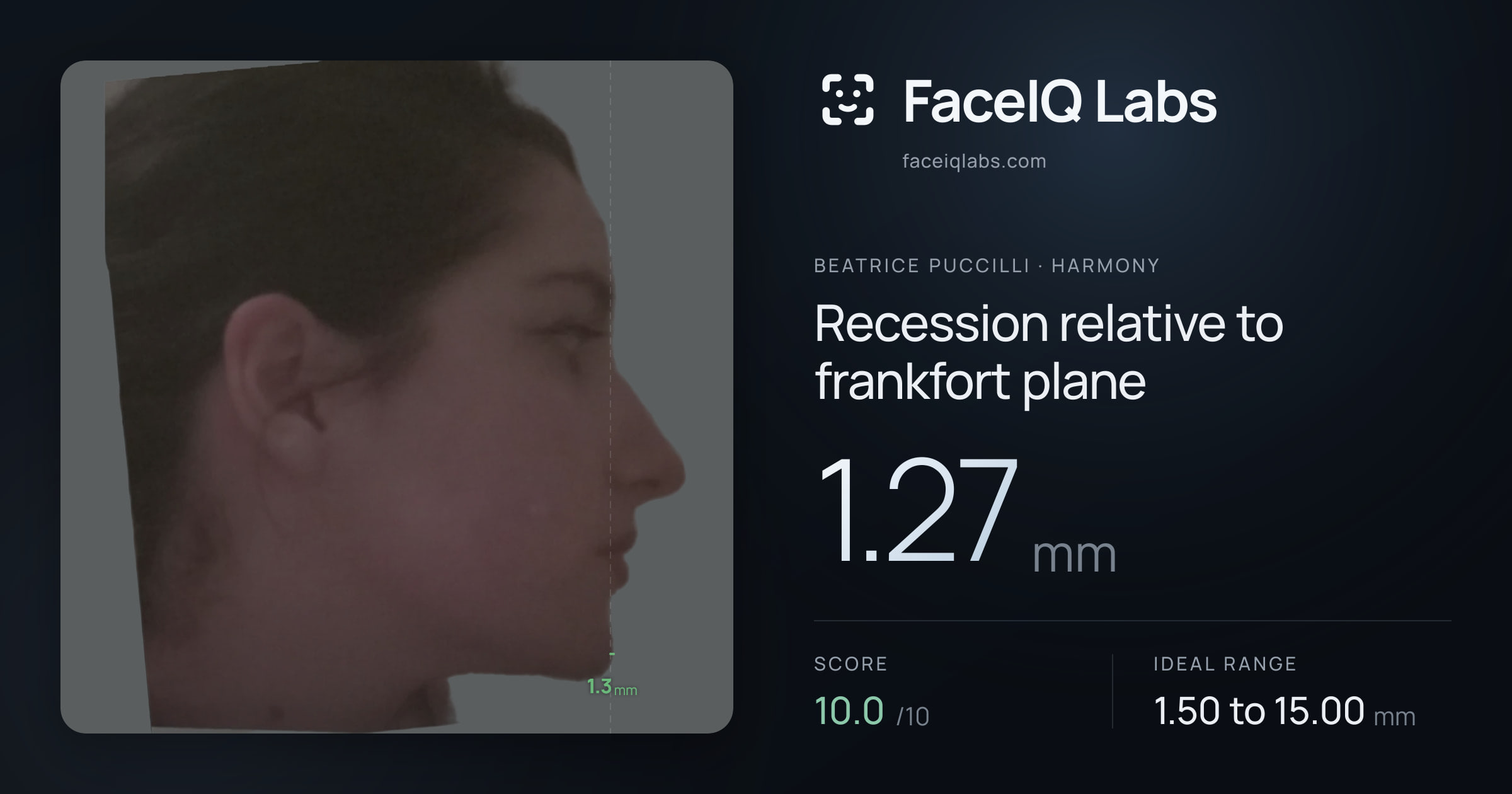 Beatrice Puccilli Recession relative to frankfort plane: 1.27mm, drawn on the photo