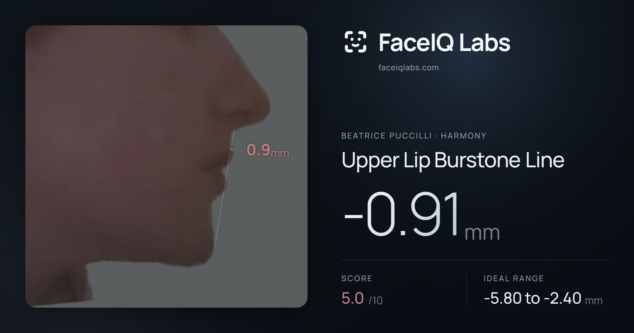 Beatrice Puccilli Upper Lip Burstone Line: -0.91mm, drawn on the photo