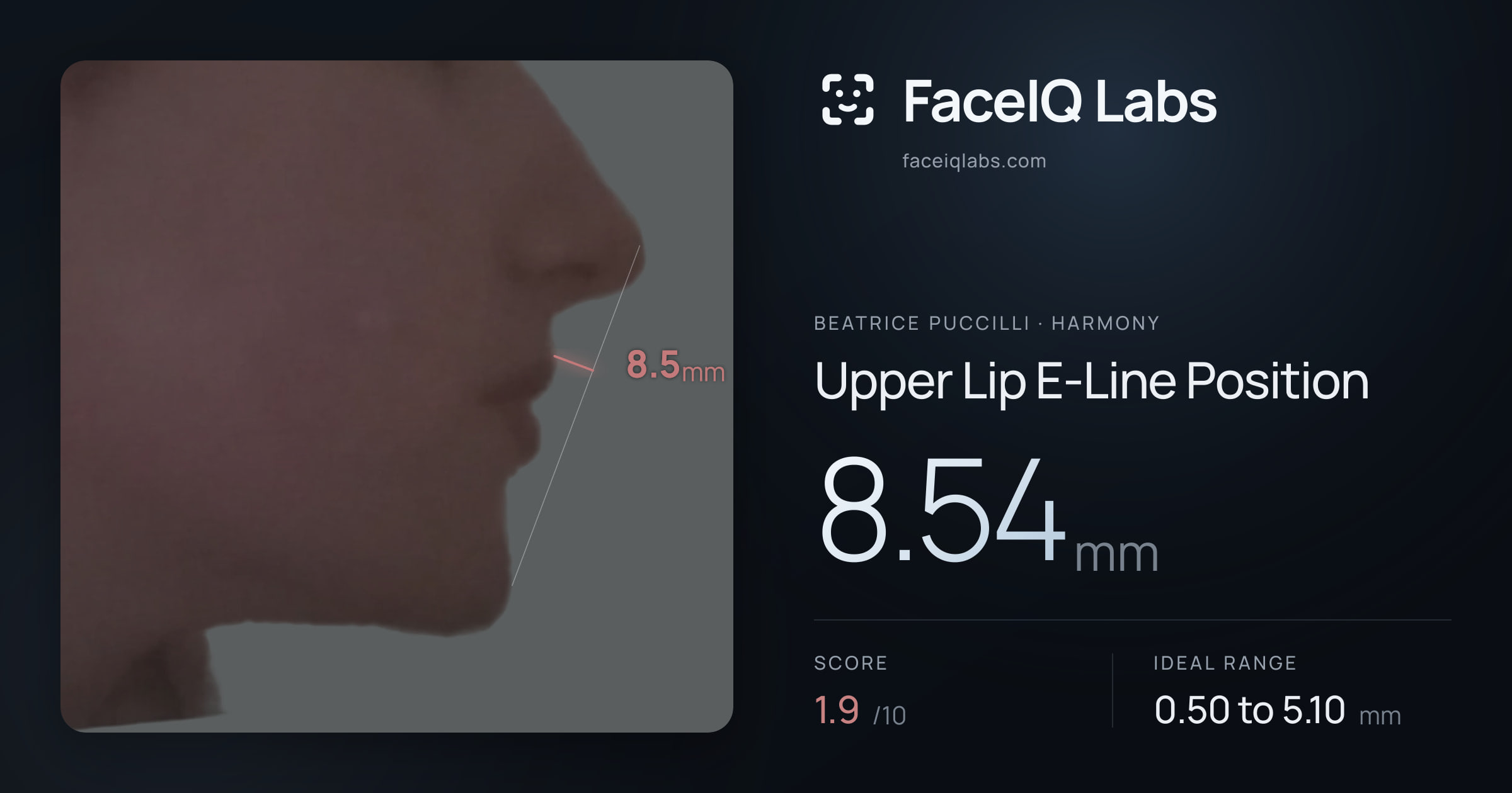 Beatrice Puccilli Upper Lip E-Line Position: 8.54mm, drawn on the photo