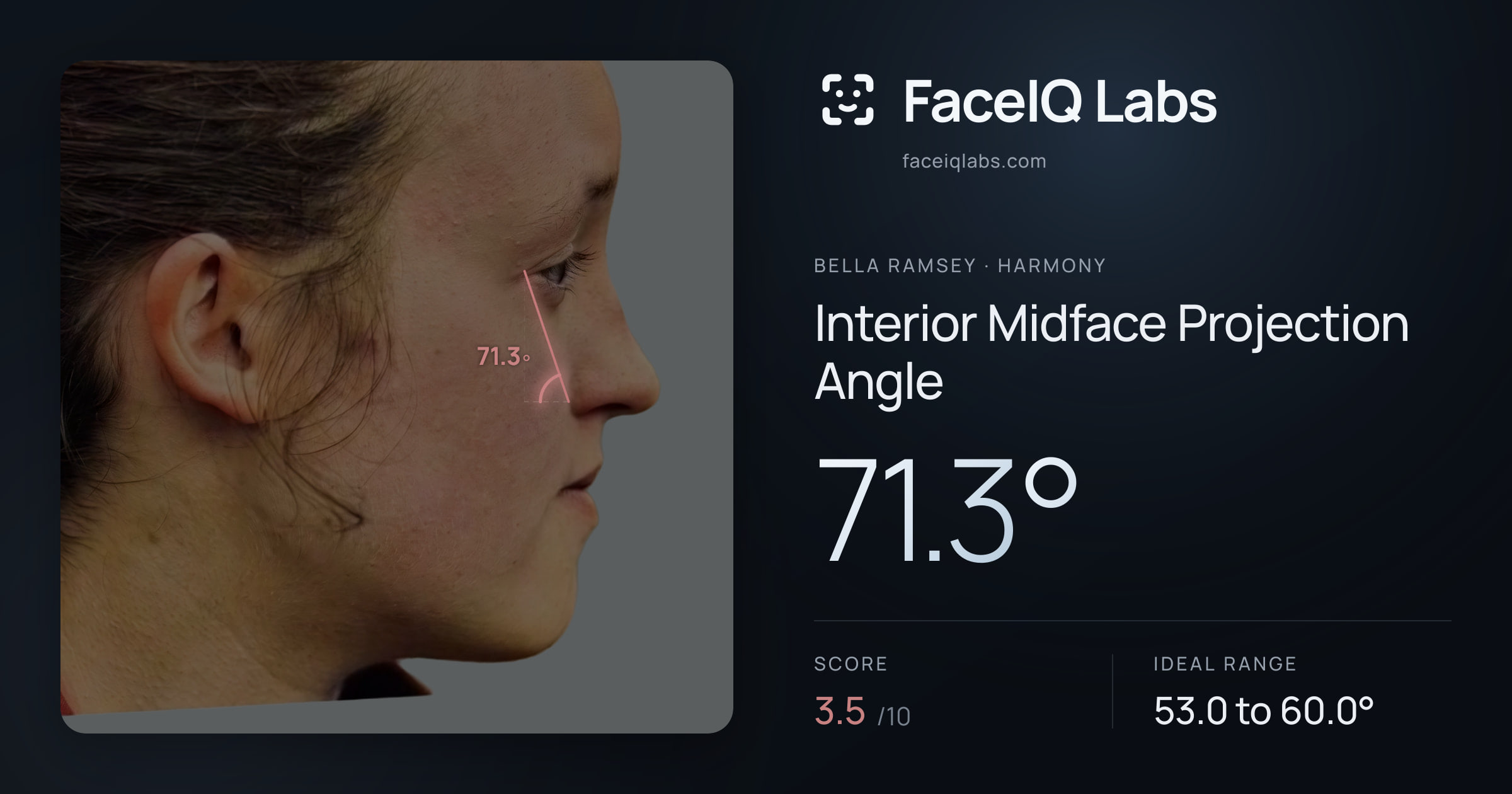 Bella Ramsey Interior Midface Projection Angle: 71.3°, drawn on the photo