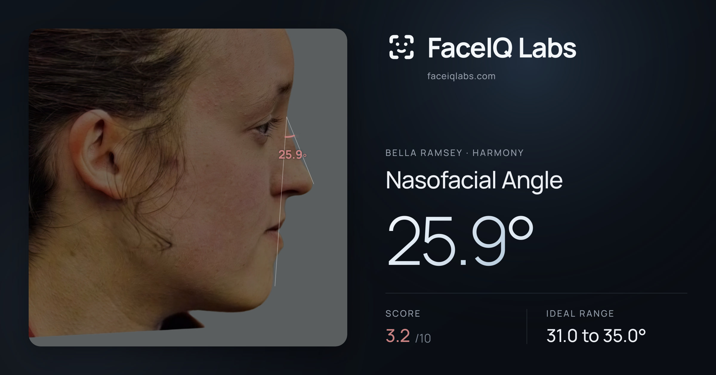 Bella Ramsey Nasofacial Angle: 25.9°, drawn on the photo