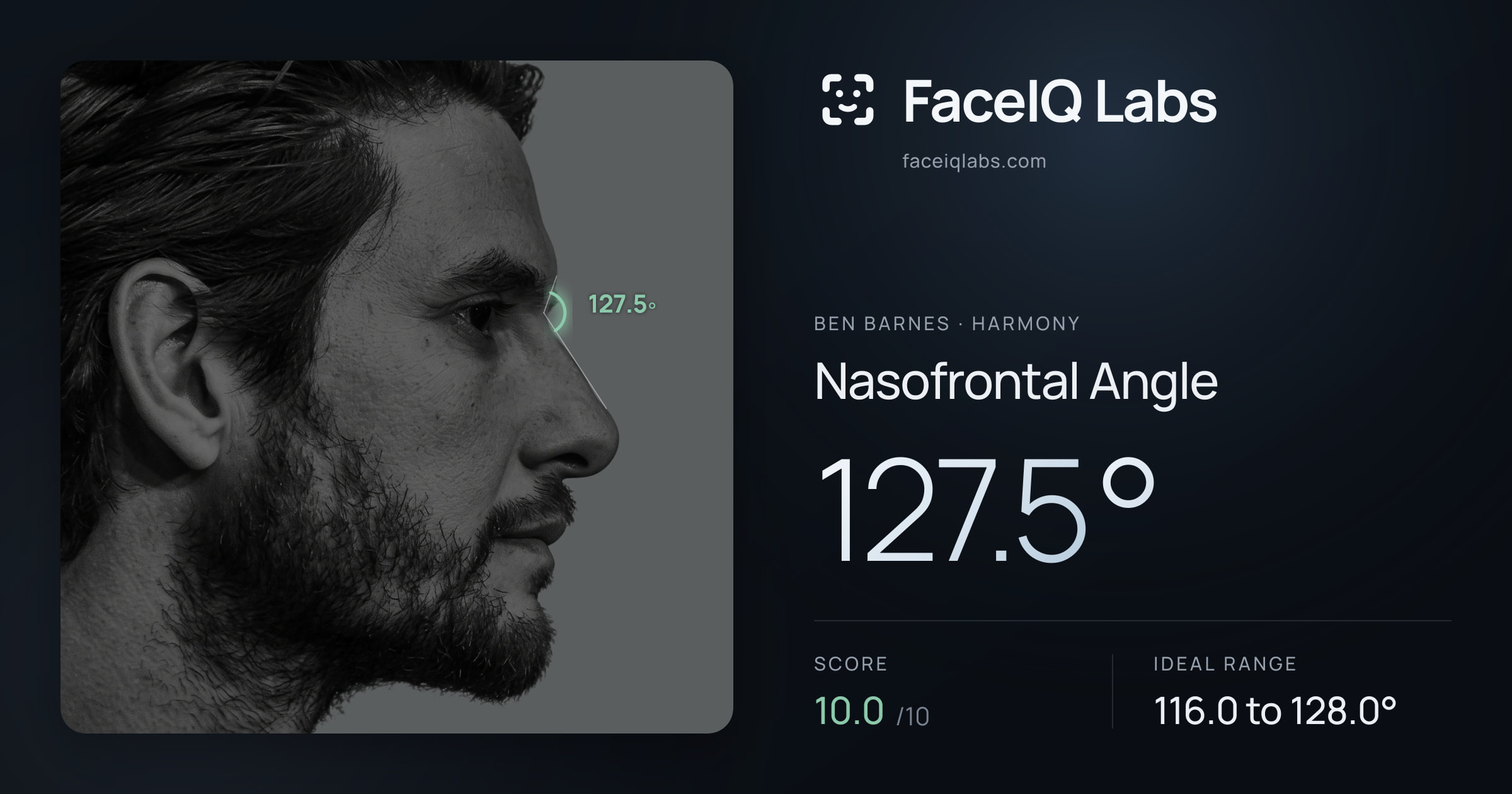 Ben Barnes Nasofrontal Angle: 127.5°, drawn on the photo