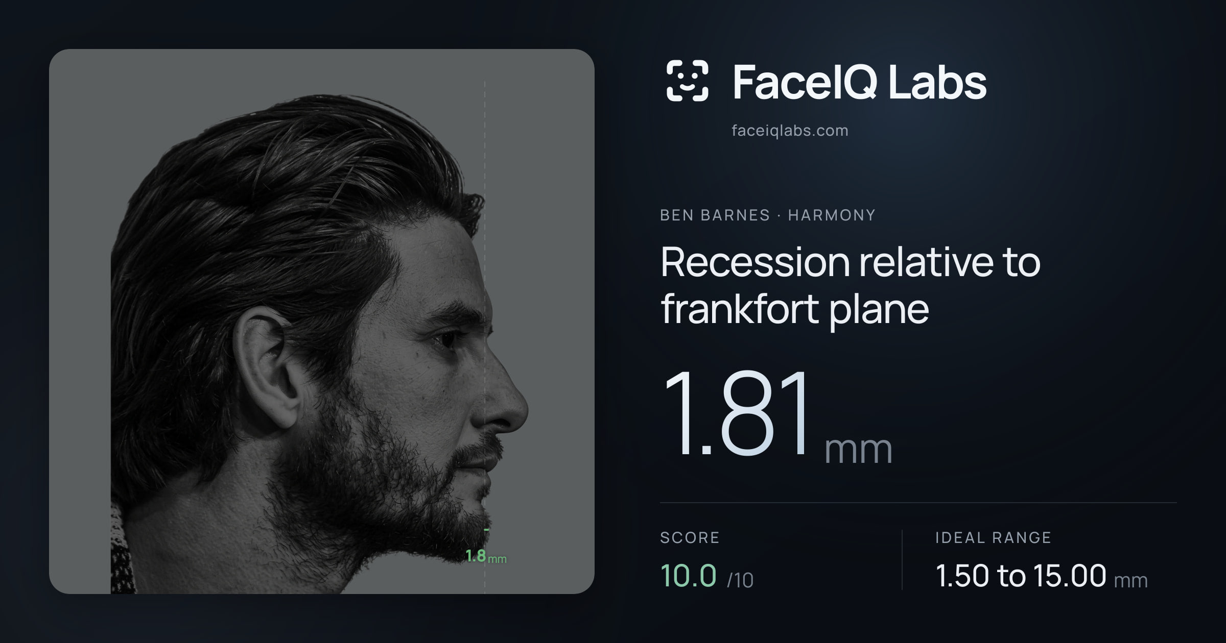Ben Barnes Recession relative to frankfort plane: 1.81mm, drawn on the photo