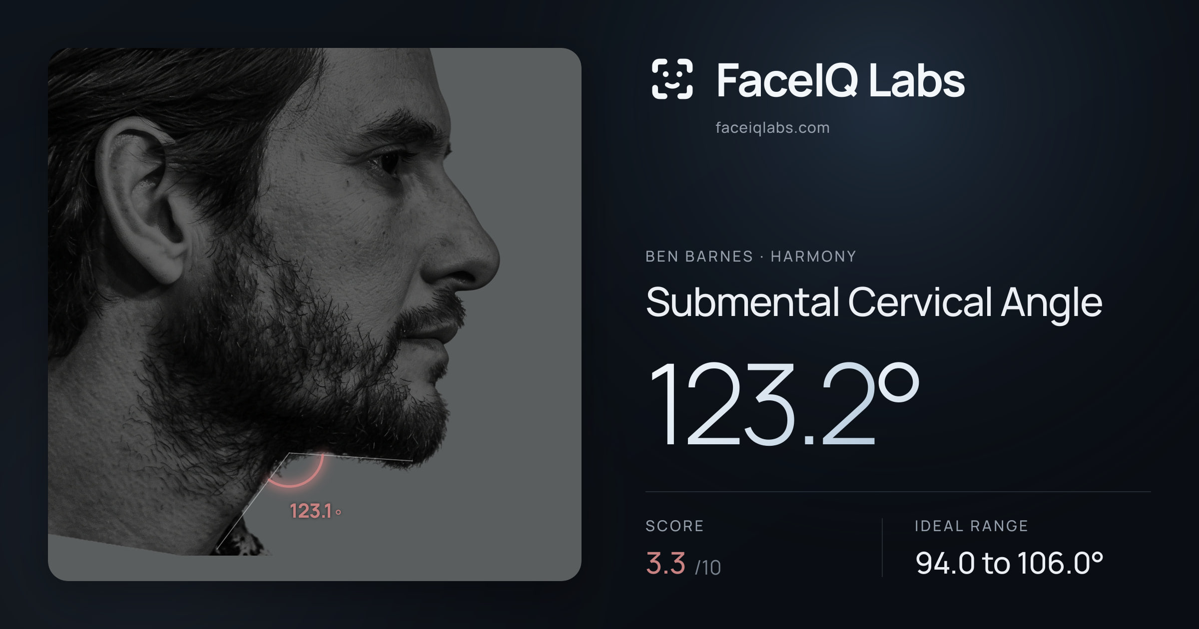 Ben Barnes Submental Cervical Angle: 123.2°, drawn on the photo