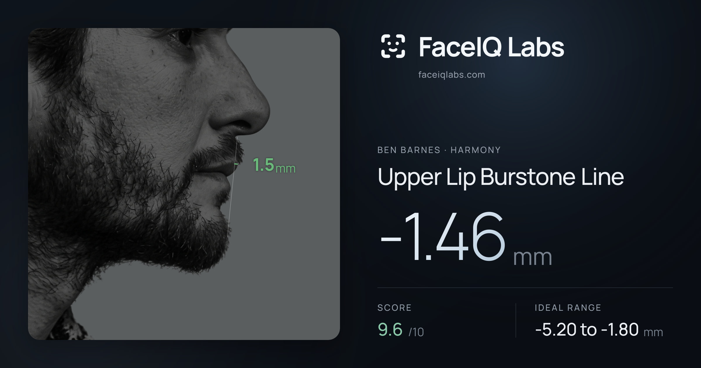 Ben Barnes Upper Lip Burstone Line: -1.46mm, drawn on the photo