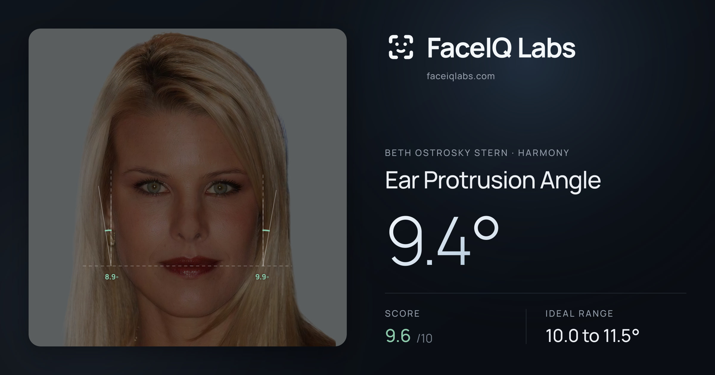 Beth Ostrosky Stern Ear Protrusion Angle: 9.4°, drawn on the photo