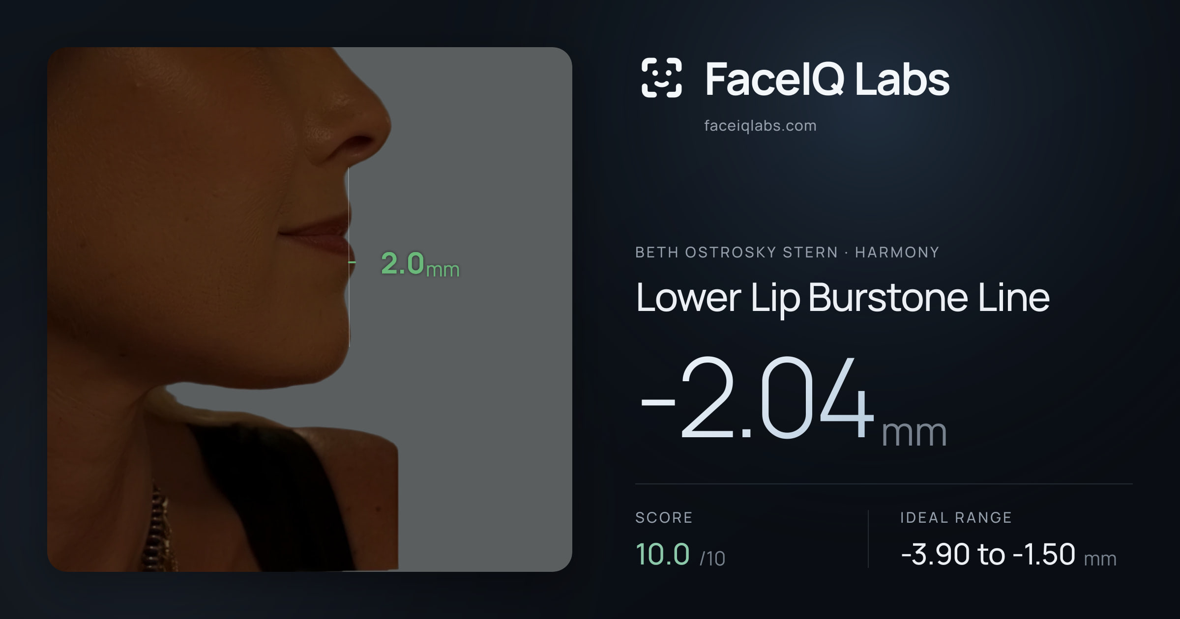 Beth Ostrosky Stern Lower Lip Burstone Line: -2.04mm, drawn on the photo