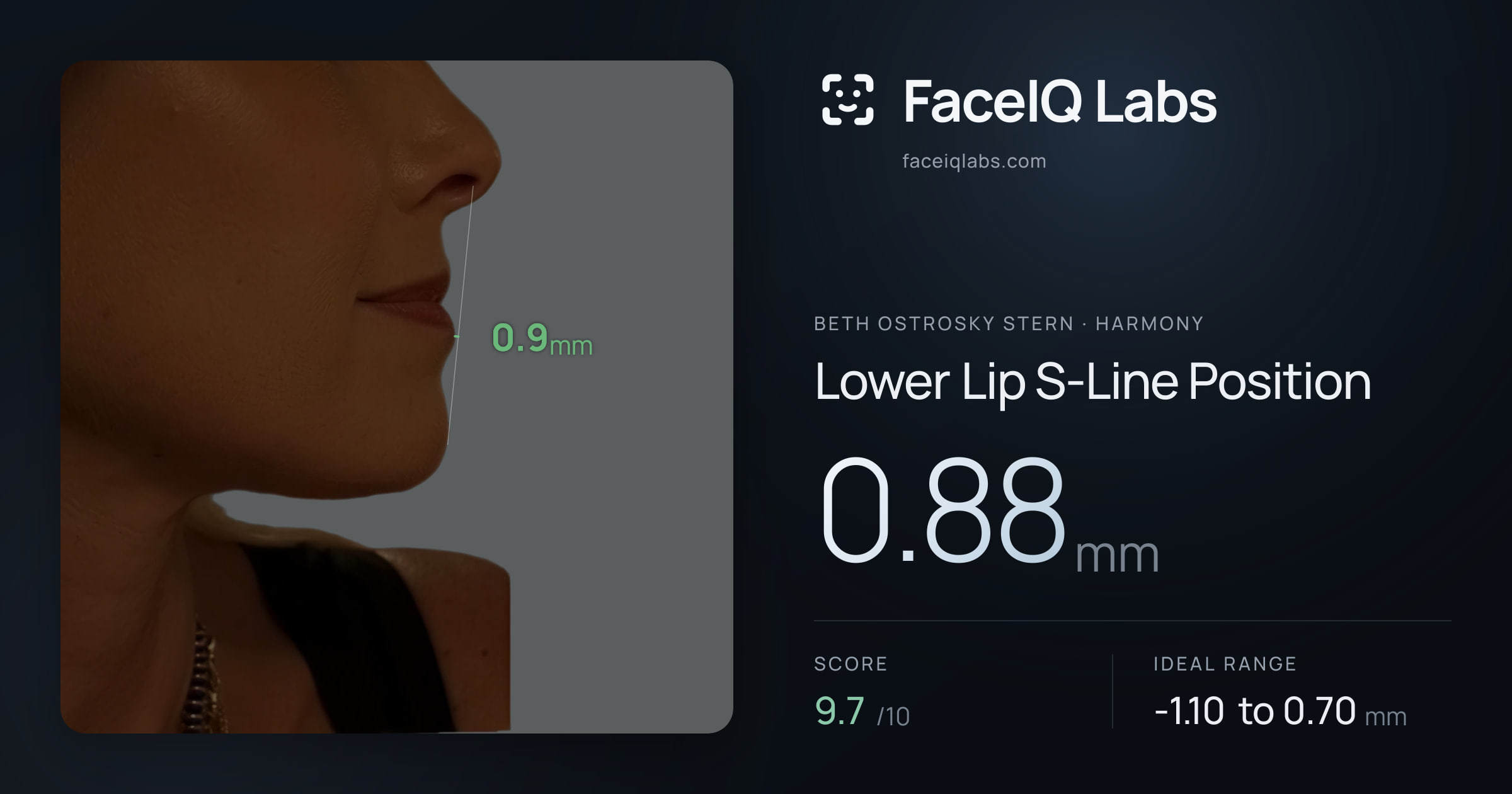 Beth Ostrosky Stern Lower Lip S-Line Position: 0.88mm, drawn on the photo
