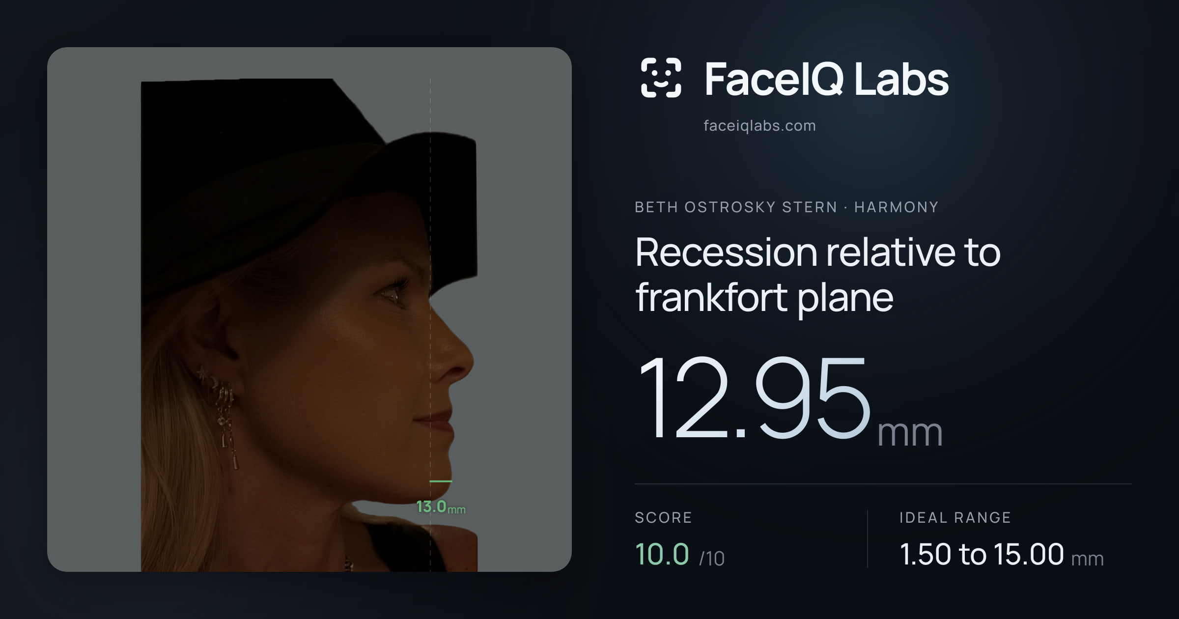 Beth Ostrosky Stern Recession relative to frankfort plane: 12.95mm, drawn on the photo