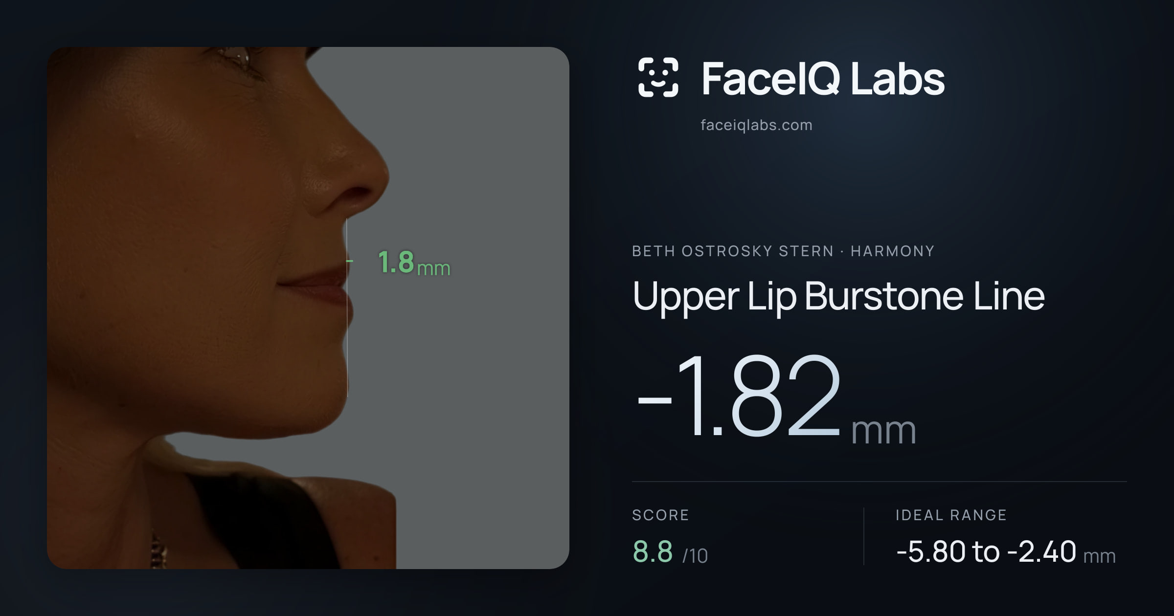 Beth Ostrosky Stern Upper Lip Burstone Line: -1.82mm, drawn on the photo
