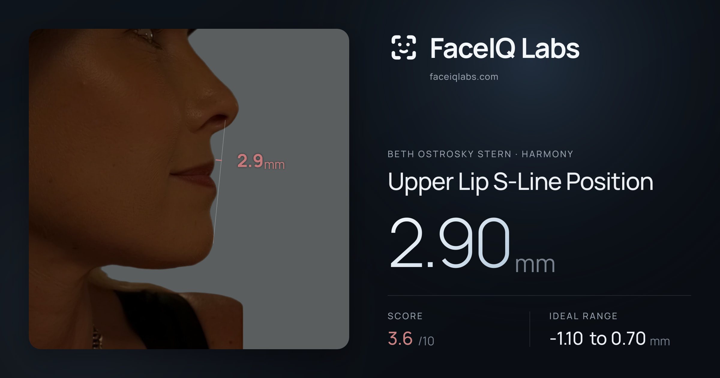Beth Ostrosky Stern Upper Lip S-Line Position: 2.90mm, drawn on the photo