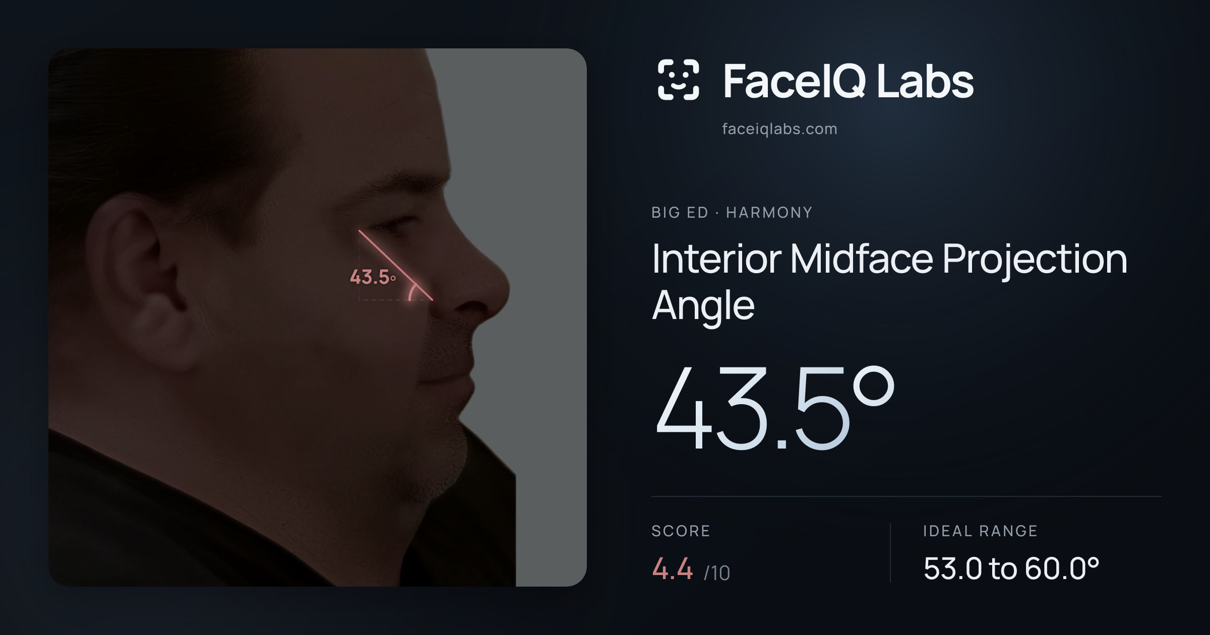 Big Ed Interior Midface Projection Angle: 43.5°, drawn on the photo