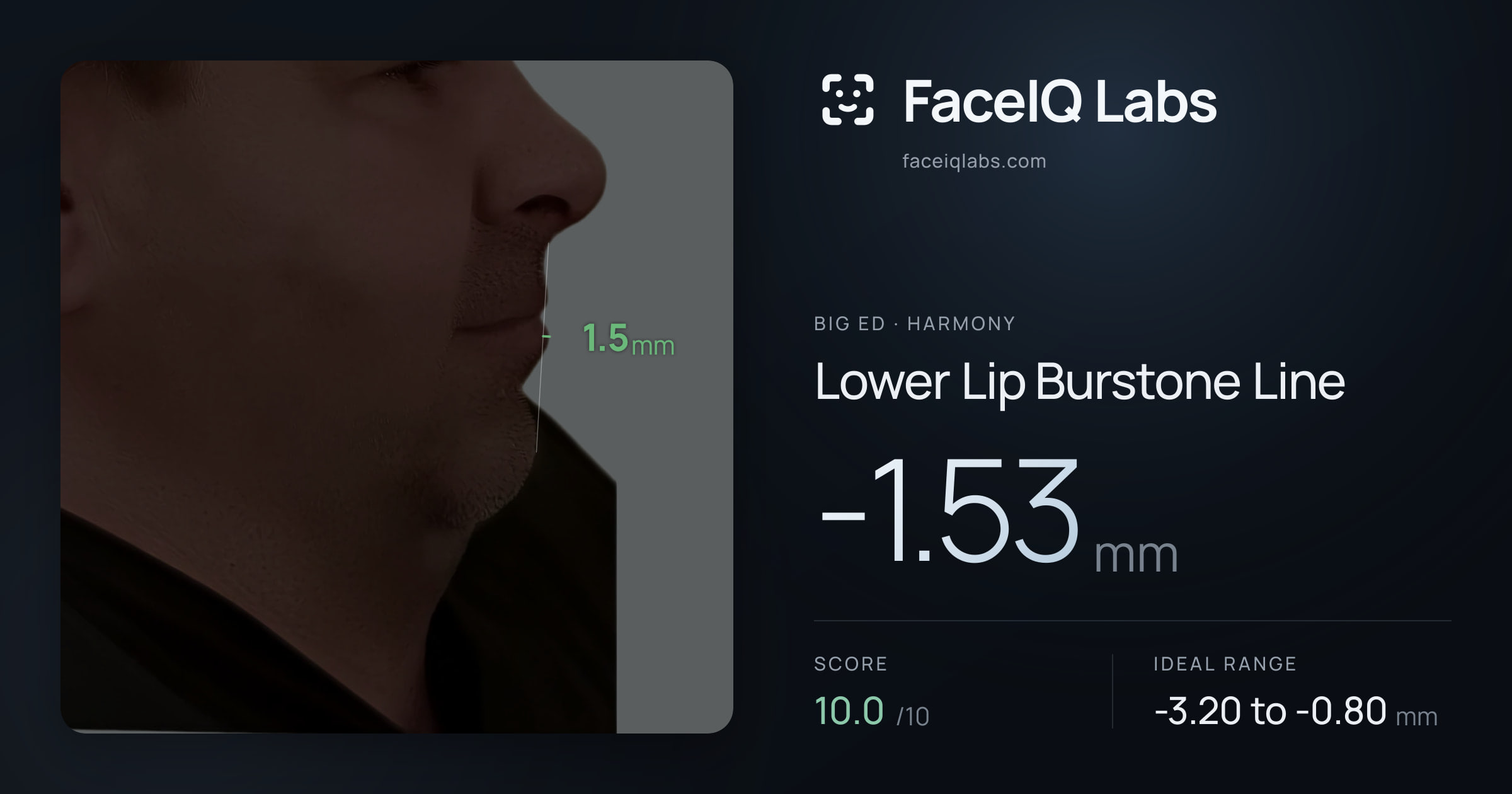 Big Ed Lower Lip Burstone Line: -1.53mm, drawn on the photo