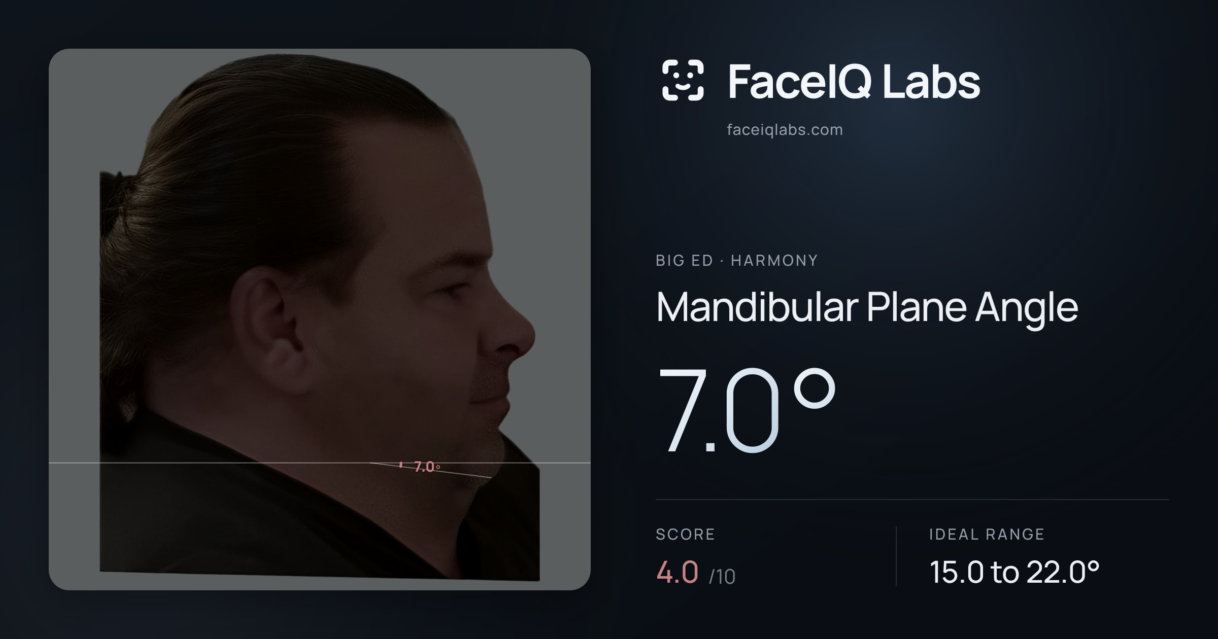 Big Ed Mandibular Plane Angle: 7.0°, drawn on the photo