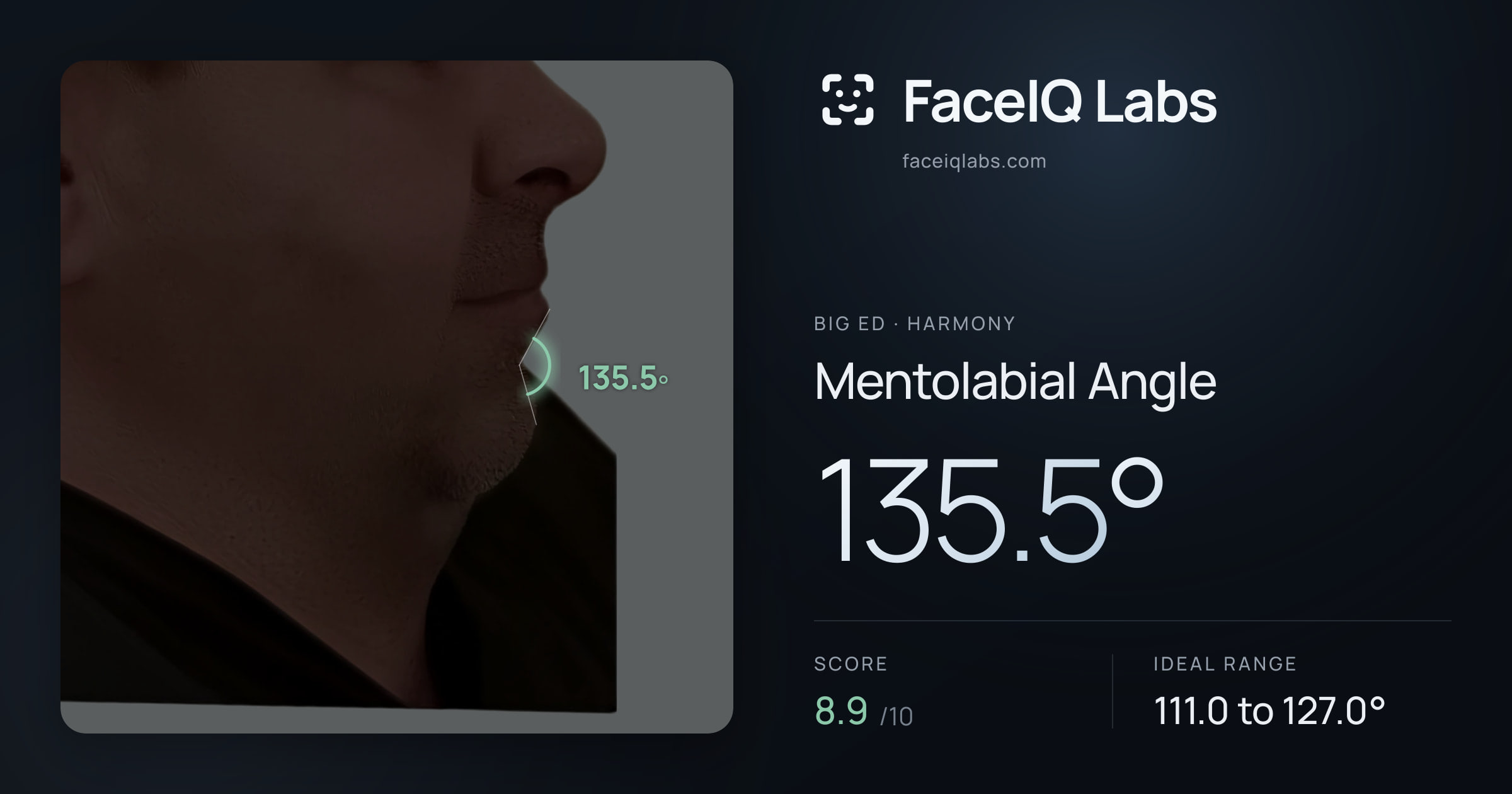 Big Ed Mentolabial Angle: 135.5°, drawn on the photo